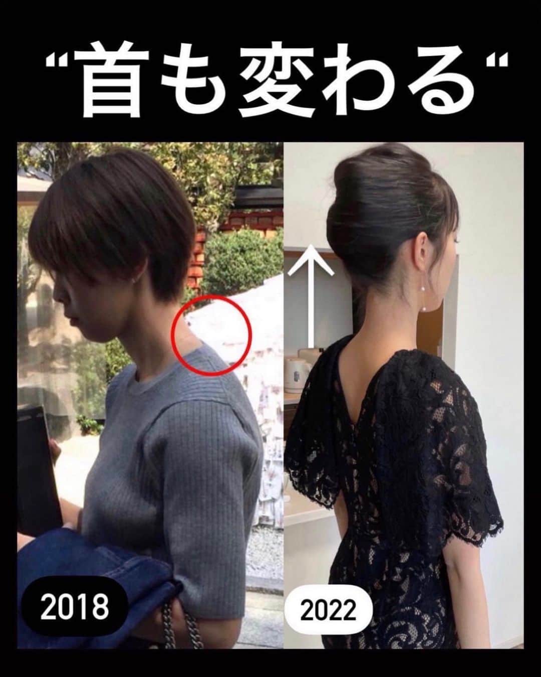 佐川裕香さんのインスタグラム写真 - (佐川裕香Instagram)「左→スウェイバック姿勢、右→よい姿勢  同じ体重、人でも見た目からだの負担も変わります！  姿勢は、形ではなく環境や動きの中で変化🌍  そのために骨のズレ、捻れを少しずつ修正 使いすぎてしまった筋肉を緩め 本来、しっかり働くべき筋肉を自然と使えるような構造に全身で変えていく✨  重力を味方に変えると お尻の形も変化していきます🦶✨  --------------------------------------------------  残り1日‼️  \月額オンラインレッスンお申込み受付け/  ▶︎募集期間 →3/4(土)23:59まで‼️  プロフィールのURL、MOSHサイトから お申込み受付けさせて頂きます✨🌸  I begin the online lesson of the monthly basis system that I turned toward the world in few days! I am looking forward to what I can give lessons in together!🌍  --------------------------------------------  \お知らせ/ ●通常5週目はお休みですが 3月29日(水)『足・脚・整える✨』 特別レッスンを開催いたします！！  とても大切な内容となっております🌱 この機会にぜひ✨  @ufix_world   --------------------------------------------」3月2日 19時32分 - yuuka_08