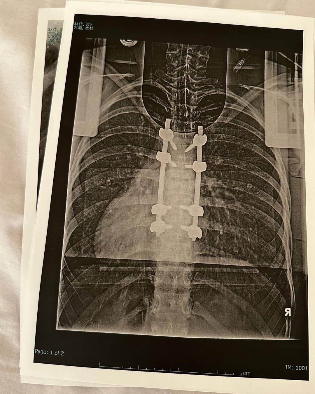 大池水杜のインスタグラム：「Bad news. I had a compression fracture in my 7th thoracic vertebra and torn ligaments. It will take some time to recover, but I will take good care of it.  I’m very grateful that I can walk on my own feet 🦶🏻  第七胸椎圧迫骨折と靭帯の損傷しちゃいました。歩いて帰ってきたのが奇跡だと言われました！少し時間がかかっちゃうけどしっかりケアしていきます😁 @visavis_jp #slopeshot #VANS #bern #タウン情報おかやま #ライト電業 #bmx #bmxgirl #bmxfreestyle #bmxwomen」