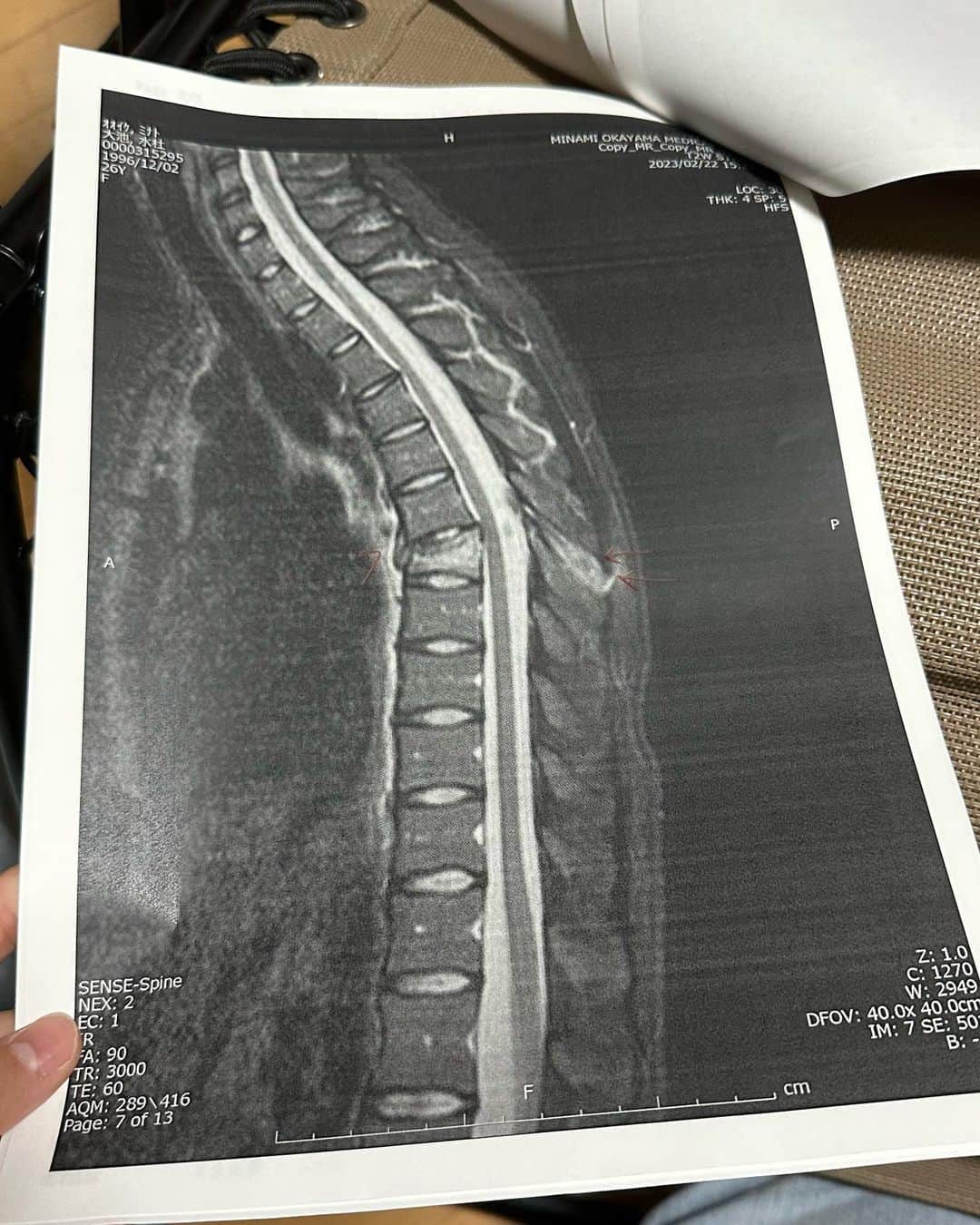 大池水杜さんのインスタグラム写真 - (大池水杜Instagram)「Bad news. I had a compression fracture in my 7th thoracic vertebra and torn ligaments. It will take some time to recover, but I will take good care of it.  I’m very grateful that I can walk on my own feet 🦶🏻  第七胸椎圧迫骨折と靭帯の損傷しちゃいました。歩いて帰ってきたのが奇跡だと言われました！少し時間がかかっちゃうけどしっかりケアしていきます😁 @visavis_jp #slopeshot #VANS #bern #タウン情報おかやま #ライト電業 #bmx #bmxgirl #bmxfreestyle #bmxwomen」3月3日 7時50分 - minato_oike