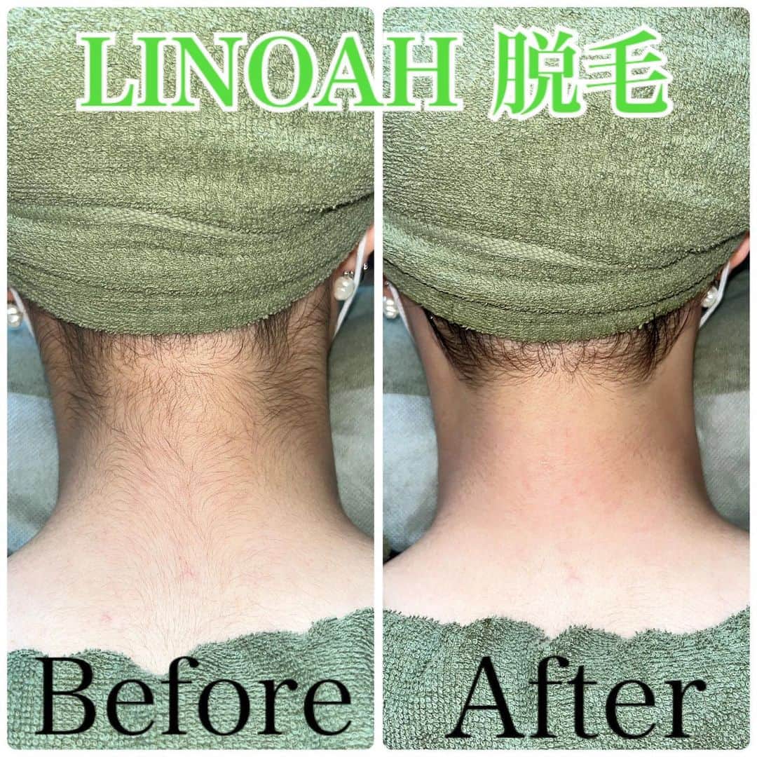 Beauty Salon LINOAHのインスタグラム：「皆様こんにちは！🌱 大阪梅田脱毛・フェイシャル BeautySalonLINOAHの京極です✨☺️  本日は女性必見！！！ 今の季節☀️特に気になるムダ毛についてです！😳  20代～30代の男性約1100名に 回答して頂いた✍️ （男性が気になる女性のムダ毛は？） というアンケートの結果、 顔に次いで、 「ワキ（40.8％）」 「うなじ（27.4％）」 「足（27.1％）」 「太もも（23.3％）」という結果が😳💦  「女性のムダ毛を見てがっかりした経験はありますか？」 という質問に対しては、 4割以上が「ある（43.8%）」 と回答しました🤦🏻‍♂️🤦🏻‍♀️  このアンケート情報を読んでいてとても驚いたのが！！  男性が女性の気になるムダ毛TOP3に、 うなじが入っている事です！！😳  実は当店でもうなじ脱毛をご利用されている方は多く、 毛がなくなるだけでとても清潔感があるように見えます！✨  今の季節、露出度も増えてくるかと思いますので、 今から是非、始めておきましょう！！  せっかくなので当店の、 ホットペッパービューティーから予約可能な ✨💁🏻‍♂️うなじ脱毛のスペシャルクーポン💁🏻‍♀️✨ 出しておきます！  【アクセス】 大阪市北区鶴野町4-11　朝日プラザ914 阪急 梅田駅茶屋町口 徒歩 5分   【営業時間】 平日　11:00～22:00（最終受付21：30） 土日祝　11:00～20:00（最終受付19：30） ※完全予約制となっております。   【定休日】 毎週木曜日   🌱ご予約・ご相談はDM📩またはこちらへ 📞06-6110-5067  #ハリウッドブロウリフト　 #ブロウラミネーション　 #次世代アイブロウ #垢抜け眉　 #眉毛パーマ  #アイブロウスタイリング　 #アイブロウ #眉ワックス #レナレビ  #大阪 #梅田脱毛  #梅田サロン　 #beautysalonlinoah  #ビューティーサロンリノア  #プライベートサロン  #フォトフェイシャル  #イオン導入 #脱毛 #脱毛サロン  #美肌 #美白 #しみ #シワ  #ニキビ跡 #毛穴 #たるみ  #HIFU #ハイフ」