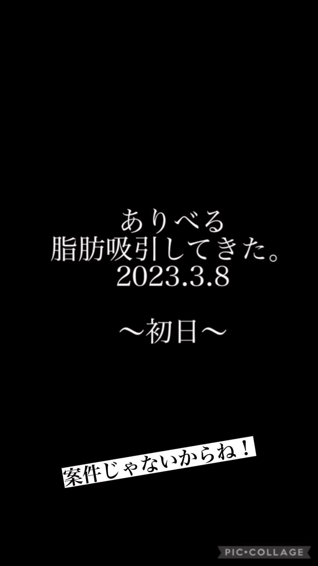 一色亜莉沙のインスタグラム：「#脂肪吸引やってみたい #脂肪吸引モニター #脂肪吸引レポート #美容モニター #3600cc取れた　#貧血 #産後の痛みに似てる　#ダイエット #諦めないで痩せる　#53キロまで頑張る　#目指せマイナス10キロ #夏までに痩せたい」