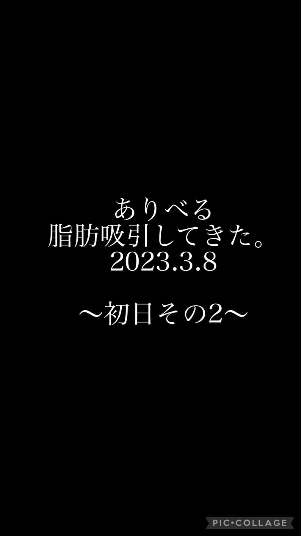 一色亜莉沙のインスタグラム：「#脂肪吸引 #脂肪吸引ダウンタイム #二の腕痩せ #お腹痩せ #くびれ作り #ダイエット記録 #美容外科医 #圧迫着 #カウンセリング #脂肪吸引レポート #脂肪吸引記録 #ダイエット仲間募集中 #痩せたい人と繋がりたい #痩せたい痩せたい痩せたい」