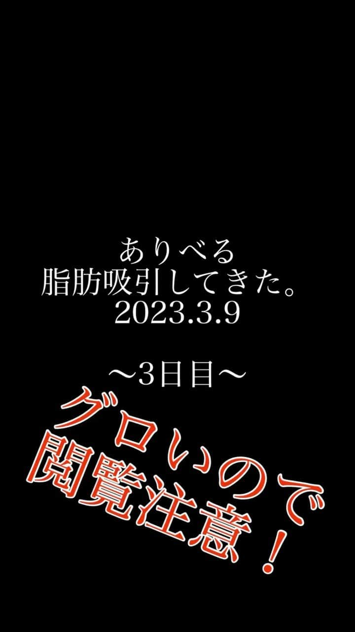 一色亜莉沙のインスタグラム：「#閲覧注意 #ダウンタイム記録 #脂肪吸引二の腕 #二の腕痩せ #二の腕ダイエット #貧血改善 #唇白 #ダイエット記録  #美容外科レポート　#脂肪吸引後ケア #脂肪吸引専門 #インディバサロン #内出血」