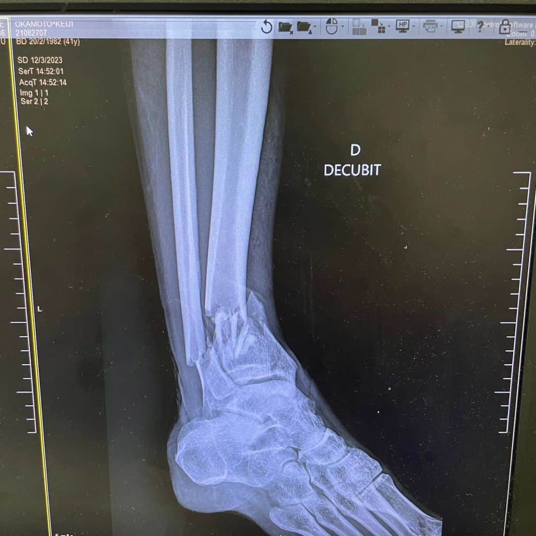 岡本圭司さんのインスタグラム写真 - (岡本圭司Instagram)「昨日のレース中にポールにぶつかり、右足を激しく骨折しました。 今は病院で処置を受けて入院していますが、このままバルセロナの病院へ転院して、何回か手術を受けてから日本へ帰国することになると思います。 今はまだあまり現実味がなく、この先どうなるかもハッキリ分かりませんが、すでに色んな方々に迷惑をかけ、この先も迷惑をかける事になってしまうと思います。 本当に申し訳なく思います。 中々人生は上手くは行きませんが、なんとか乗り越えたいと思います。 そして親にもらった身体を粗末にしてしまって申し訳なさでいっぱいです。 皆さん、本当にすみません。」3月13日 16時47分 - hywod_kj