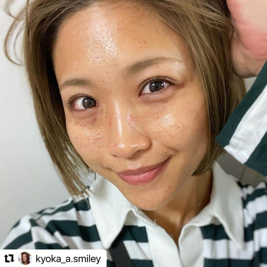 YAG BEAUTY CLINICさんのインスタグラム写真 - (YAG BEAUTY CLINICInstagram)「渋谷院 エクソソーム ご来院ありがとうございます(*^^*) . .  #Repost @kyoka_a.smiley with @use.repost ・・・ .  YAGBEAUTYCLINIC @yagbeautyclinic_shibuya で気になってたエクソソーム注射受けてきた🤭✨ 1枚目1週間後▷▶▷2枚目直後写真  【エクソソーム】  肌の再生効果を促す、ヒト脂肪幹細胞由来の 「エクソソーム」は安全性・安定性に優れており、 様々な肌トラブルを解消し、究極の皮膚再生 （肌の若返り）効果を発揮します🥹🫶🏾  🤍効果🤍 ・皮膚再生(はり、くすみ、シワ、乾燥) ・抗酸化作用(老化) ・抗炎症作用(赤ら顔、ニキビ跡) ・ターンオーバー促進 ・コラーゲンやエラスチンを生成する  少しだけ痛かったのとダウンタイムあるから数日内出血あるけど 内出血引いてきたあたりから見ても触ってもわかるトーンアップと手触り 無加工でこれも綺麗けど回数重ねるともっと良くなるらしい！！ 頑張って続けよー🥳  《安藤京香のInstagramを見た》で 通常価格55,000円のところ 50%offで受けられます😘.*･ﾟ ※当院ご来院初めての方限定 ※針麻酔代 別途8,800円  ✎︎＿＿＿＿＿＿＿＿＿＿＿＿  #パーソナルトレーナー #パーソナル  #食事指導 #ボディメイク #健康美 #ダイエット #モチベーション  #東京 #撮影会モデル #モデル #ポートレート #pr #yagbeautyclinic #渋谷 #エクソソーム #ヒト幹細胞 #無加工 #すっぴん」3月15日 10時44分 - yagbeauty_official