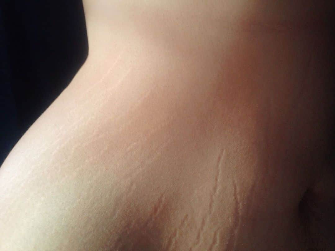 Eileen Kellyさんのインスタグラム写真 - (Eileen KellyInstagram)「Stretch marks happen when your body grows quickly. They’re common during growth spurts in puberty, pregnancy, and from weight gain and weightlifting. Any person can get stretch marks.   Stretch marks are common and normal. Up to 90% of people have them. Over time, some stretch marks may fade and become slightly lighter than the color of your skin. Other stretch marks may remain red or purple. Think of them as your “stripes” – a sign that your body is growing with you 🐅」4月10日 4時49分 - killerandasweetthang