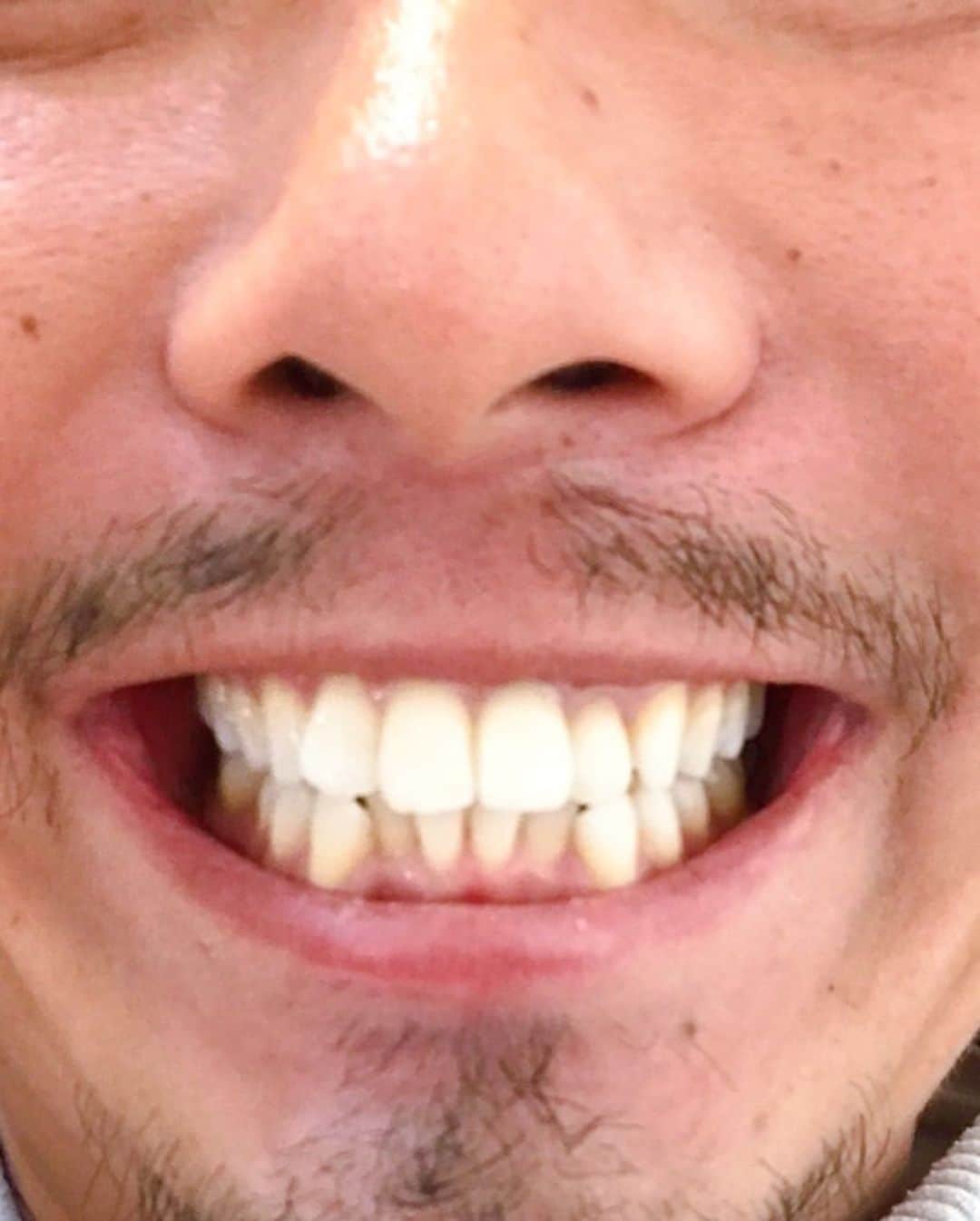 ジェイク・リーさんのインスタグラム写真 - (ジェイク・リーInstagram)「Teeth Whitening Time🦷🦷🦷  #noah_glg」4月10日 17時32分 - jakelee19890119