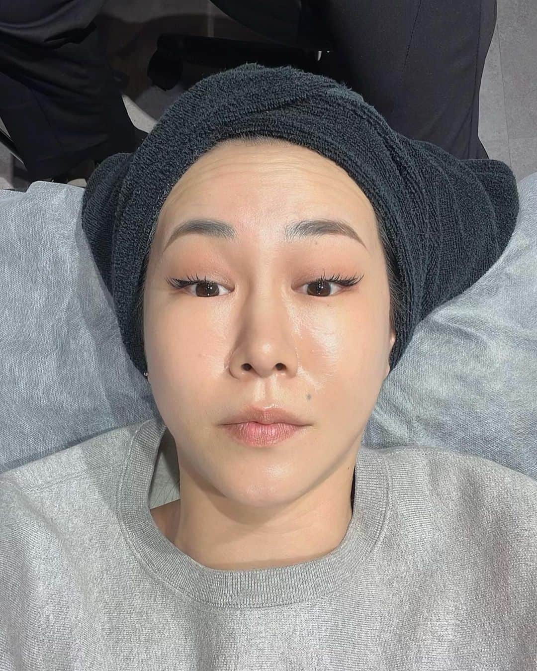 須田朱音さんのインスタグラム写真 - (須田朱音Instagram)「𝖠𝗋𝗍𝗅𝗈𝗎𝗇𝗀𝖾 𝖼𝗅𝗂𝗇𝗂𝖼.  先日、推し活前に信頼してる @dr.yoko_alc 先生にお任せして、 人生2度目の額ボトックスしてきました。  前回から、約7ヶ月ぶりかな？ 痛みに弱い私も麻酔クリームだけで大丈夫でした。  ダウンタイムもなし、目の重さや違和感もなく おでこつるつるになりました♡  元麻酔科医の陽子先生は注入とってもお上手なので、 悩んでる方はカウンセリングに行ってみてね‼︎  📍 @artlounge_clinic  #artlounge #artloungeclinic #ボトックス #アートラウンジクリニック」3月21日 17時46分 - akane_godo