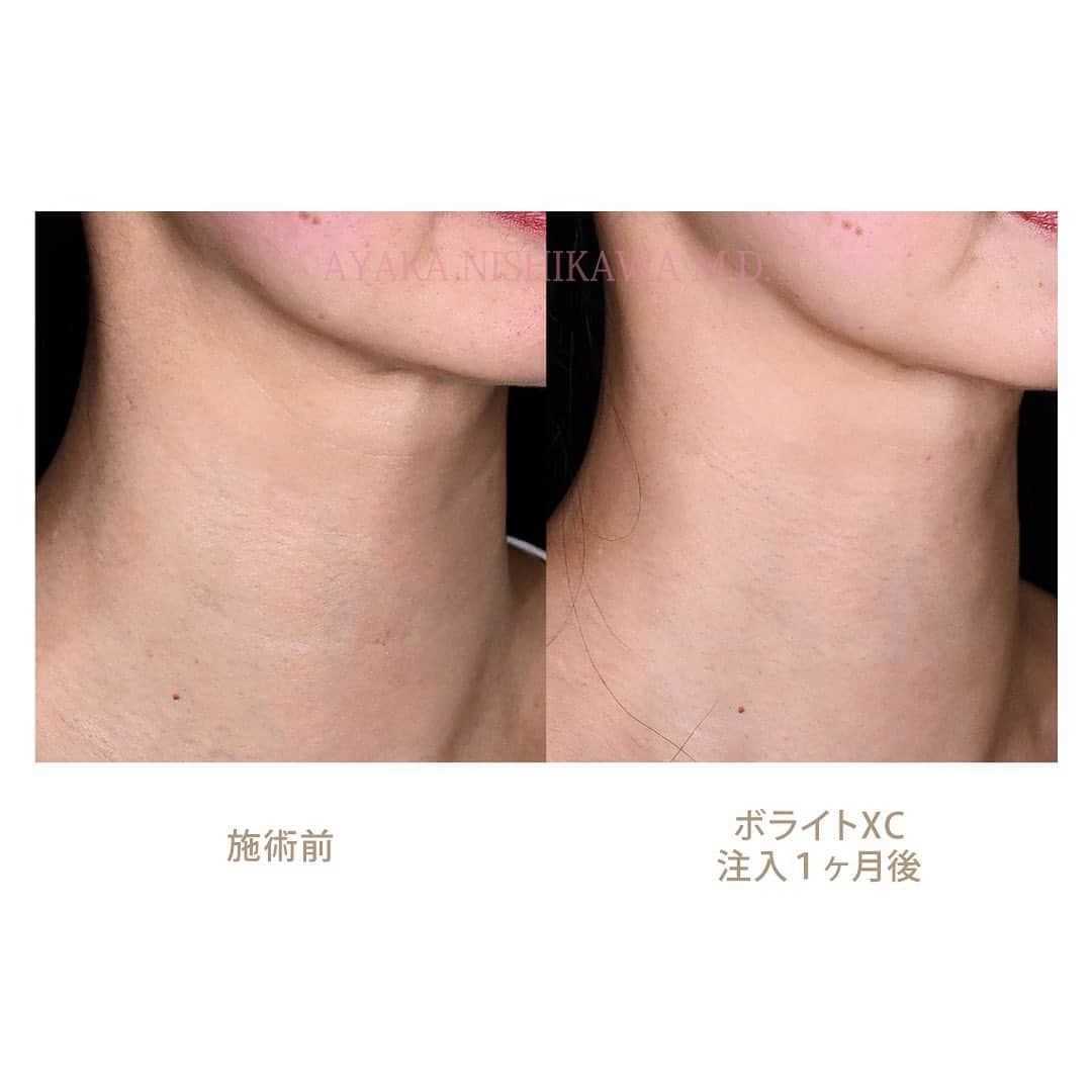西川礼華のインスタグラム：「首の横ジワが気になる方へのヒアルロン酸注入って、実は難易度が高く、どうしても、頸部ボトックス、女優注射、プレミアムPRP等で対応させていただいていた現状がありました。 この度、首の横ジワの治療として最適なヒアルロン酸製剤として#ボライト を新しく導入しましたので、その症例を紹介します。 ボライトというヒアルロン酸を注入することで、体内に存在するヒアルロン酸と結びつきさらなる保水力を与える作用があります。顔や首などの皮膚の浅い層（表皮～真皮層）に注入することで、「肌のハリ・うるおい」「小じわ」「毛穴」「弾力」などの改善が期待できます。 ボライトを注入するとコラーゲンが増えるというデータも出ており、一時的な保水効果だけでなく根本的なアンチエイジング効果もあるのではないかと期待の製剤です。また、厚労省認可をとっているのも安心ですよね。シワへの効果は約4ヶ月ほどと言われております。  ボライトXC首1本使用 【通常価格】 1本(1.0cc) 58,000円税込 【モニター価格】 1本(1.0cc) 47,000円税込   施術の副作用：疼痛・腫れ・内出血・血管閉塞・アレルギー・感染・硬結を生じる可能性があります。  #volite  #首のシワ #保湿 #保水効果 #毛穴改善 #湘南美容クリニック #美容皮膚科医 #西川礼華 #ayakanishikawa」