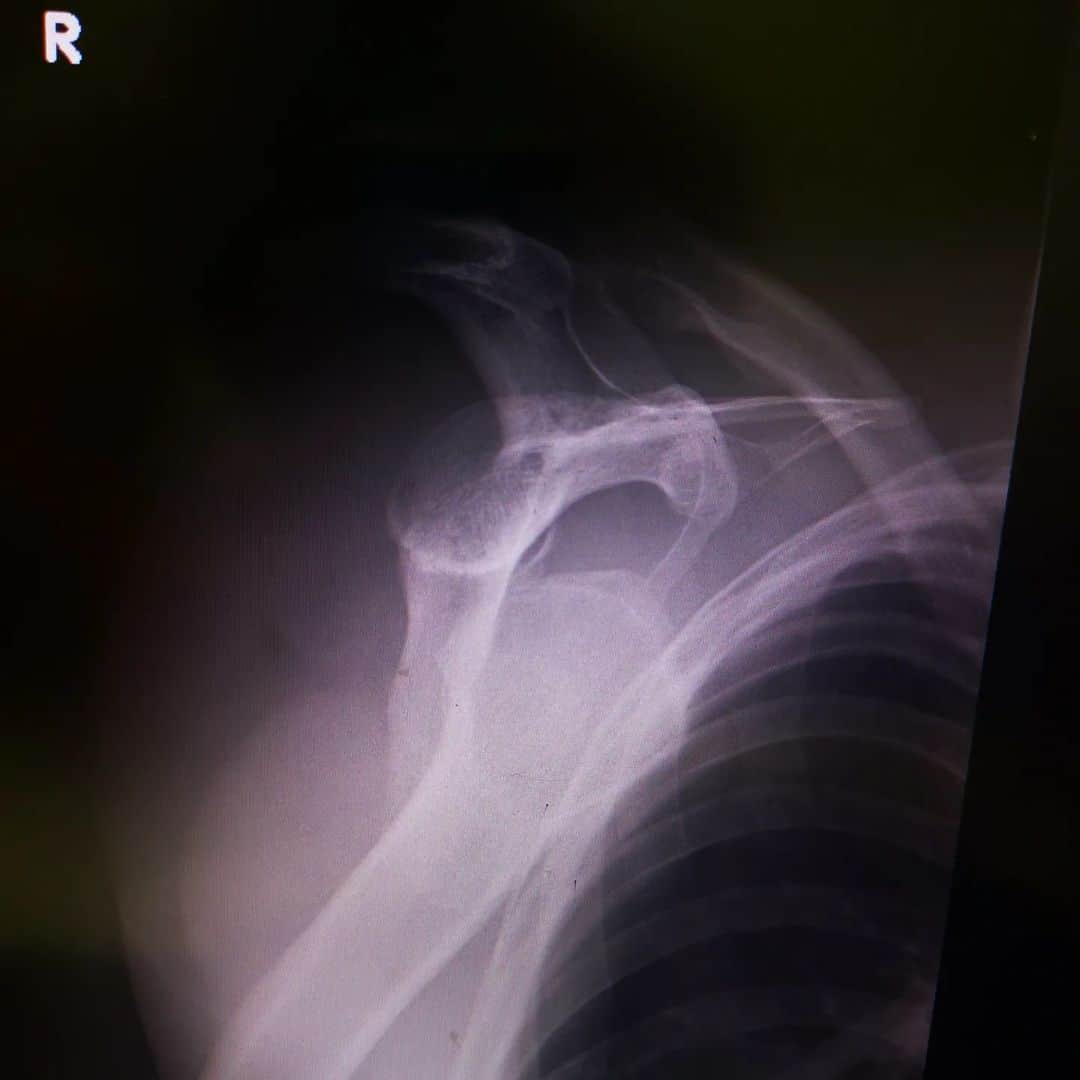 CIMAさんのインスタグラム写真 - (CIMAInstagram)「My right shoulder dislocation 🦴 😖 #GLEAT #LIDET #STRONGHEARTS」3月22日 17時00分 - supercima1115
