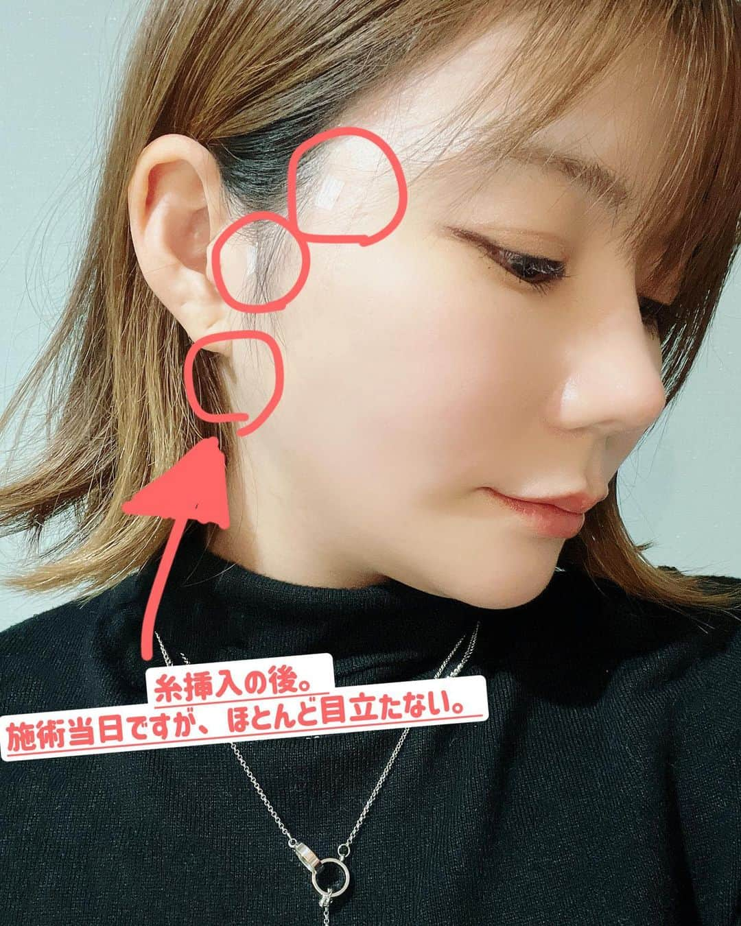 玉樹るいさんのインスタグラム写真 - (玉樹るいInstagram)「先日、#東京中央美容外科宇都宮院 （@tcb_utsunomiya)で#tcb式小顔美肌再生 を受けてきました！  最近、撮影出来ない理由の一つ。 フェイスラインの弛み、、、。  ハイフや、EMS、顔の筋トレなどリフトアップに良さそうなもの試してみましたが、なかなか思うように効果が出ず😢 やりたい髪型もできない、撮影も行けないで悩みに悩んだ結果。これは物理的に引き上げてもらおう😭ということで思い切って糸リフト🪡やってきました❗️  担当していただいた宇都宮院の岡本先生（＠tcb_okamoto_takuya）。 実は以前から糸リフトの症例拝見していて、術後の写真とても綺麗で当日とても楽しみに病院へ✨  カウンセリングで先生にお会いした印象は、とっても物腰柔らかくて丁寧に話す先生でした☺️具体的に鏡をみながら『こことここを持ち上げたらフェイスライン綺麗になりますよ』とわかりやすく説明していただき、ぜひお願いします🙇‍♂️ということでマーキングしていざ施術❗️  施術中、麻酔はまぁ痛いけども我慢できる程度の痛み。先生も 『今から強く押します、こっから痛いですよー』と、都度都度声かけてくださったり、看護婦さんも足のあたりをトントンしてくれながら 『頑張ってくださーい、もう少しですよ』 とずっと声かけてくださりとても心強くて気づいたら終わってました。 なんか麻酔入ってからは全く痛くなくてあっという間でしたね✨  終わって鏡を見せていただいてびっくり🫢口横のハムスターみたいなもっちり肉がいなくなってる⁉️  いやー、感動しました、、、。脂肪吸引しないとここまでVラインは出ないかなと正直思ってたので、ここまで変われるとは‼️😭 1ヶ月後の仕上がりでより綺麗にしてもらうために結構強めに引き上げてもらったので、術後すぐなため、頬骨横あたりはまだ麻酔液が残って腫れていたり，引き上げが強いですが、徐々に馴染むそうなので仕上がりがとても楽しみです😊✨  #美容外科ならTCB東京中央美容外科 #東京中央美容外科 #美容外科 #TCB #美容クリニック #美容医療 #美容 #リフトアップならTCB東京中央美容外科 #小顔美肌再生 #TCB小顔リフト #リフトアップ #糸リフト #小顔整形 #小顔 #美肌 #宇都宮 #プチ整形 #美容整形 #整形」3月23日 21時33分 - abitara1118