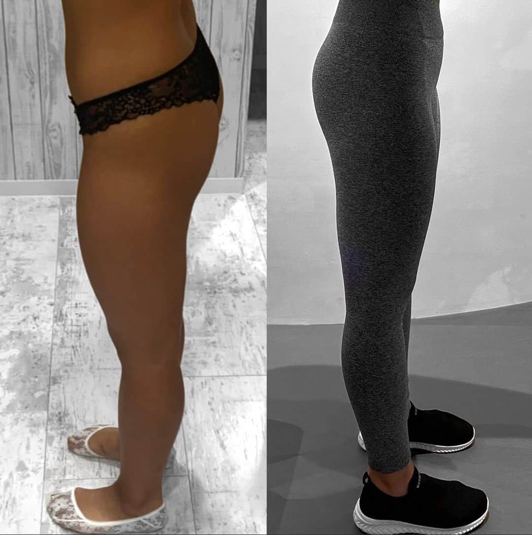 Miyunaのインスタグラム：「ボディーメイク始めて  ✴︎脚長くなった ✴︎身長のびた  って言われるようになりました。  ちなみに右は左の写真より体重+3kgくらい重い🐷  4月入ったらしっかり減量✨  #ヒップアップ効果  #ビフォーアフター  #ボディメイク  #ダイエット #モチベーションアップ   #beforeandafter  #bodymaking  #fitgirls」