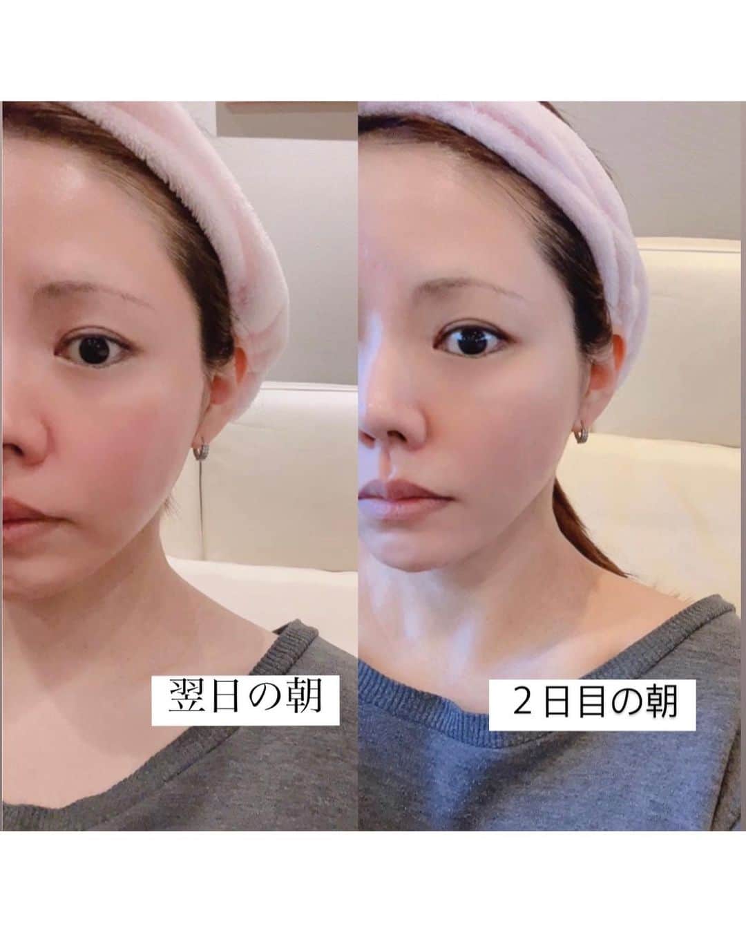 本田裕子さんのインスタグラム写真 - (本田裕子Instagram)「@rinrin_yuko  . こんばんニャー🐱(=^∀^=) . 落書き楽し〜 なんちゃって 笑 . 顔につけているのは、お家で簡単に本格的なハーブピーリングができるキット🌿 . BQCELL ダーマスキンピーリングを お試ししてみました（先月末に😀） . 注射器みたいな中に入っているピーリング剤を 洗顔後の肌に塗布💉 . ピーリング塗布後は洗い流さずに７時間以上時間をおくとのことで👀オススメ通りピーリンングをしたまま夜寝ました😴  翌朝は顔の火照り＆赤くなって水洗いすると少しヒリヒリ。。。3日目くらいから皮むけが始まって、洗顔時とかポロポロ取れる感じで4日目で少し赤みが引いてきました。 . 5〜６日後ぐらいまでは特にいいと思わなかったけど、1週間〜10日後ぐらいに肌がツルツルもっちりして効果を実感🥚 . ダウンタイムがあるとのことで、ここ最近の私は、スケジュール的に1週間とか人と会わないのは難しく、なかなか試せずにいたんだけど、2日間だけ自宅にこもってzoomのみのタイミングでやって、３日目から外出＆ヨガのレッスンもしてましたが（まだ皮むけ中で、どうしたの？って聞かれたりw）と火照りと皮むけが辛かった😂←けど完了時と約1ヶ月経った今は、本当に大満足です╰(*´︶`*)╯♡ . 皮剥けタイプのハーブピーリングは、美容皮膚科やエステだと、結構高いからコスパも良いと思う◎ . . ただ、5日目とか6日目でも 外に出れる状態じゃないから （私は出てたけど😂） スケジュールに余裕がある時でないと なかなか難しいと思う。 . . とはいえ、 お肌のツルツル具合は クセになる😍w . . あと、付属でついている鎮静アンプルと、BQCELL ダーマスキンクリーム（これはナイアシンアミドやツボクサエキス配合）は保湿力や使用感もすごく良かったです♡ . やっぱ個人的に韓国コスメ、 大好きです😊 . ピーリング後は乾燥するから、 保湿をたっぷりしましょうね🙋🏻‍♀️ （あと日焼け止めも😉） . . @gangnam_doll　 のURLからも購入可能だよ🎶 . . . …… #韓国コスメ #韓国美容 #ダーマスキンピーリング #毛穴ケア  #韓国スキンケア #BQCELL #ダーマスキンクリーム #カンナムドール #ミーオンリアルレビュー #pr #韓国ドクターズコスメ #韓国コスメ大好き #美肌ケア #美容好きな人と繋がりたい #美意識アップ #スペシャルスキンケア #ハーブピーリング #美容家 #ヨガインストラクター #おこもり美容 #本田裕子」3月26日 22時57分 - rinrin_yuko