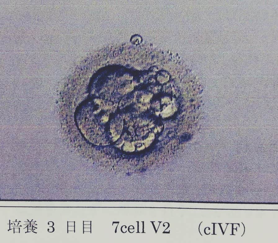 松井理子さんのインスタグラム写真 - (松井理子Instagram)「先日の土曜日受精卵がどうなったか結果を聞いてきました。  無事分裂をし、3日目で7つのと他少しの細胞だそう。初期杯のグレードとしては良いとの事。この状態で卵子凍結してますと。  ほっと一息😅  次はまた卵子を採卵を選択せず今のこの子を体に戻す方向で考えてます🌸  #不妊治療 #初期杯凍結 #44歳 #旦那さんは52歳 #仲良し夫婦」3月27日 23時12分 - ume_ume_phot
