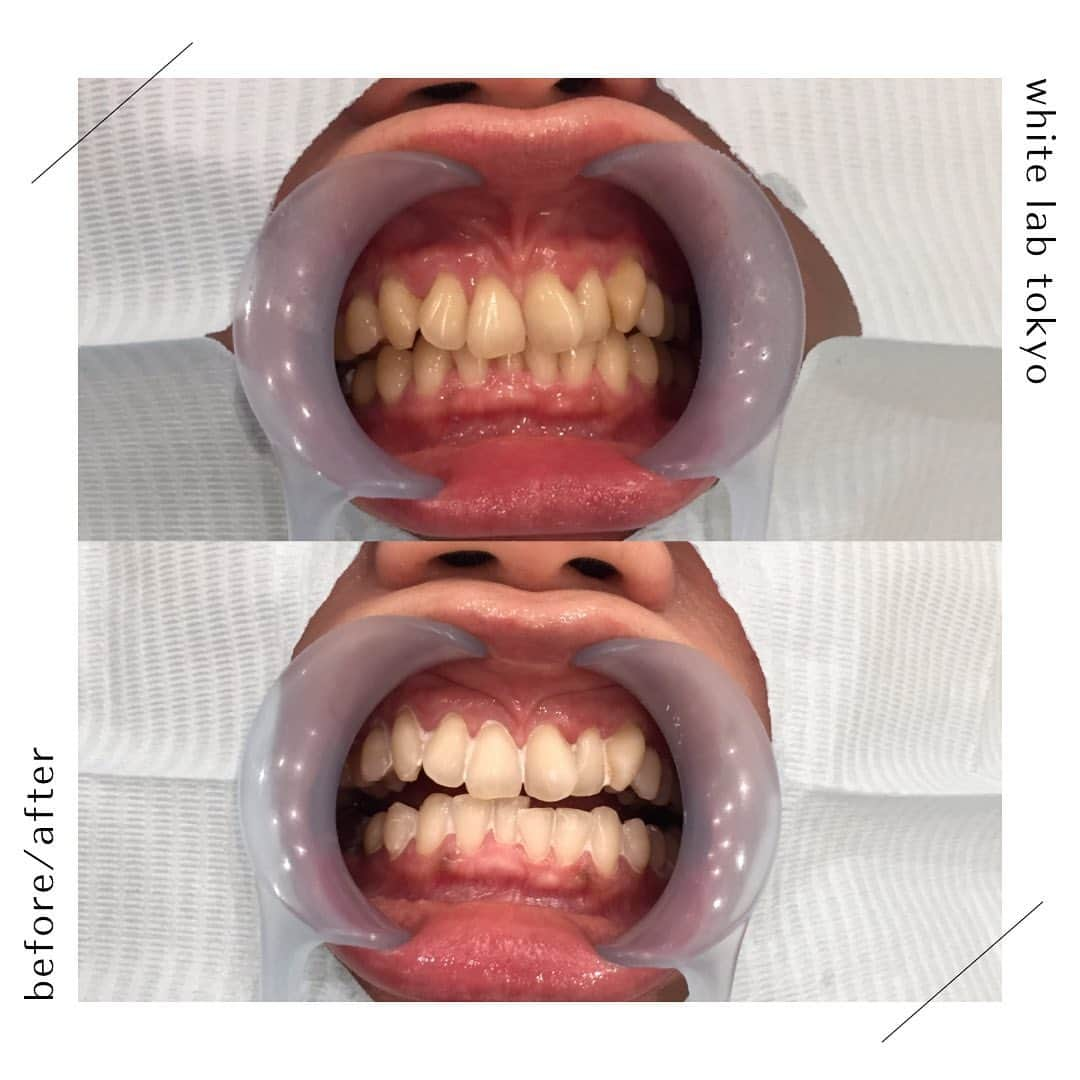 ホワイトニング専門クリニック ホワイトラボ東京 渋谷のインスタグラム