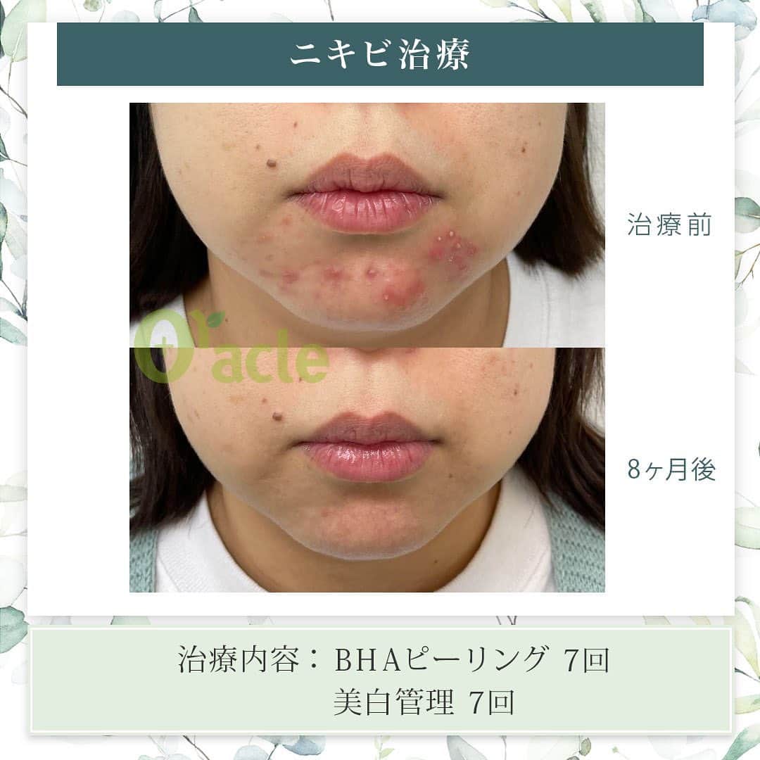 オラクル美容皮膚科東京新宿院さんのインスタグラム写真 - (オラクル美容皮膚科東京新宿院Instagram)「|◤ニキビ治療症例◢|  《治療内容》 BHAピーリング7回 美白管理7回 →顎ニキビが改善しました  ☑️BHAピーリング 高濃度サリチル酸ピーリングです。お肌の表面を殺菌し、繰り返し行うことでニキビはできづらいお肌に改善  【ダウンタイム】▶︎ほぼありません 赤み：数時間 皮剥け:1週間 洗顔、メイクは当日から◎ ⁡ 【料金】 1回　11,000円 ▶︎面ぽう圧出、ゴムパックつき ⁡ ☑️美白管理 ニキビのお肌は乾燥している方が多く、その乾燥がニキビの原因になっているいることも。 美白管理では、お肌の状態に合わせてビタミンＣ、もしくはトラネキサム酸をお肌に導入していきます。 ⁡ 【料金】 1回　11,000円(税込)  ※トラネキサム酸orビタミンC ☞肌状態でお選びいたします。 ⁡ #ピーリング  #ニキビ治療 #ニキビ肌 #ニキビ跡 #ニキビケア　#新生活準備  #韓国美容 #皮膚科　#美容皮膚科 #ニキビ　#ニキビ改善」3月27日 18時25分 - oraclejp