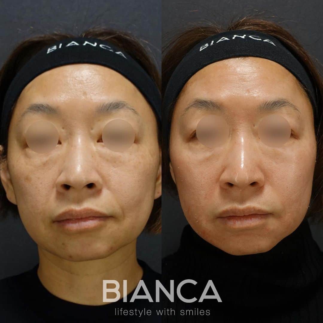 辻沢由有（BIANCA CLNIC 表参道院 院長）さんのインスタグラム写真 - (辻沢由有（BIANCA CLNIC 表参道院 院長）Instagram)「複合治療で美肌へ✨  ピコスポット✖︎ゼオスキンセラピューティック 3ヶ月目の方です。 A反応による赤みや皮剥けがありますが、 もうすでに美肌になっています🤍  ただゼオスキンを買えば良い、ただレーザーをすれば良い、 お肌治療はそんな単純なものではないですし、 その方一人一人によって適応の治療も方法も なにもかも違います🙅‍♀️🙅‍♀️  ※どうかインターネットの安価なものや、 診察なし（もしかは買ってからフォローのない） クリニックで医療コスメを買わないでください🥺 医療コスメは、化粧品ではなく「治療」です。  ゴールに合わせてしっかりフォローしていきますので、 いつでもご相談ください🥰  #ゼオスキン#セラピューティック #シミ取り #ピコスポット #ピコトーニング #肌質改善」3月29日 16時33分 - i_am_yuu__