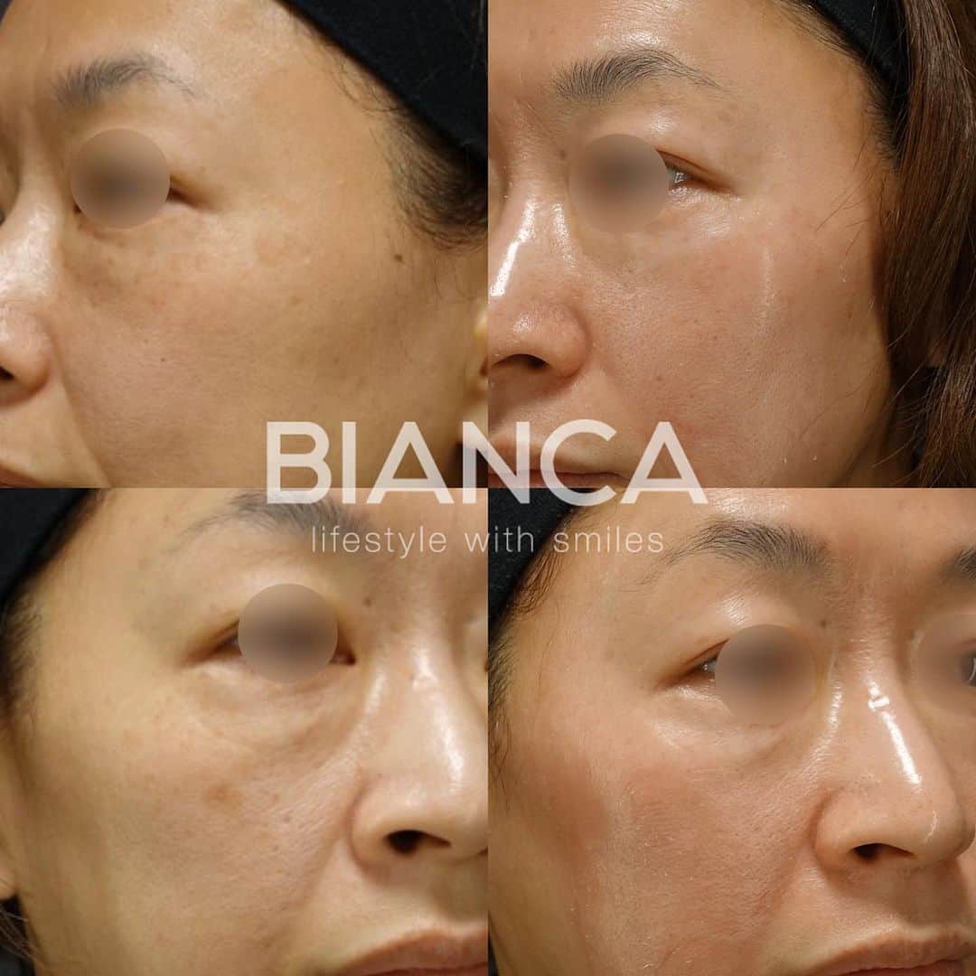辻沢由有（BIANCA CLNIC 表参道院 院長）さんのインスタグラム写真 - (辻沢由有（BIANCA CLNIC 表参道院 院長）Instagram)「複合治療で美肌へ✨  ピコスポット✖︎ゼオスキンセラピューティック 3ヶ月目の方です。 A反応による赤みや皮剥けがありますが、 もうすでに美肌になっています🤍  ただゼオスキンを買えば良い、ただレーザーをすれば良い、 お肌治療はそんな単純なものではないですし、 その方一人一人によって適応の治療も方法も なにもかも違います🙅‍♀️🙅‍♀️  ※どうかインターネットの安価なものや、 診察なし（もしかは買ってからフォローのない） クリニックで医療コスメを買わないでください🥺 医療コスメは、化粧品ではなく「治療」です。  ゴールに合わせてしっかりフォローしていきますので、 いつでもご相談ください🥰  #ゼオスキン#セラピューティック #シミ取り #ピコスポット #ピコトーニング #肌質改善」3月29日 16時33分 - i_am_yuu__