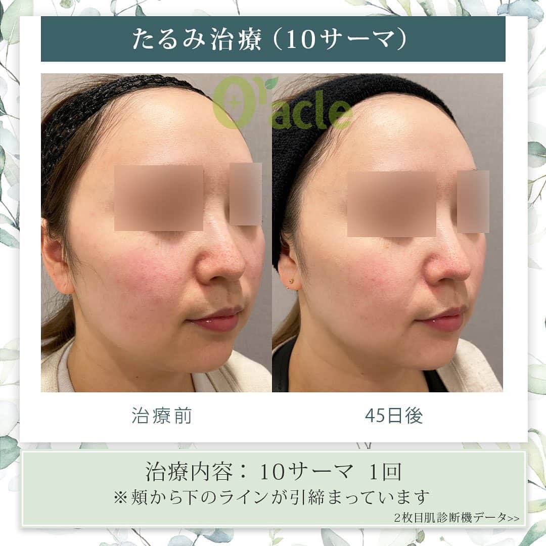 オラクル美容皮膚科東京新宿院さんのインスタグラム写真 - (オラクル美容皮膚科東京新宿院Instagram)「|◤高周波によるたるみ治療症例◢|  《治療内容》 10サーマ（テンサーマ）1回 →45日後経過 →30日後の肌診断（VISIA）による測定  ☑️10サーマ 治療目的▶ 顔の脂肪縮小 肌のハリ フェイスラインやほうれい線のたるみ改善  モノポーラ式高周波を用いた引き締め治療。 ●韓国のMFDS承認機器 ※日本の厚生労働省にあたる機関 ●各種特許取得  🇰🇷韓国では2022年11月にリリースの最新機種 韓国では高周波が人気で、韓国国内外で130以上のクリニックに導入されています。  【ダウンタイム】▶︎ほぼありません 赤み：ほぼなし、出ても数時間から1日程度 洗顔、メイクは当日から◎ ⁡ 【料金】新宿院先行導入 200shot 88,000円（気になる部分） 400shot 165,000円（全顔） 600shot 220,000円（全顔＋顎下） ※全て税込  #10THEMA #10ソマ #高周波 #引き締め #たるみ #弾力 #韓国 #美容 #フェイスライン #ほうれい線 #美容皮膚科 #アンチエイジング #韓国好きな人と繋がりたい #韓国情報  #たるみ改善 #若返り #顔痩せ」3月30日 17時02分 - oraclejp