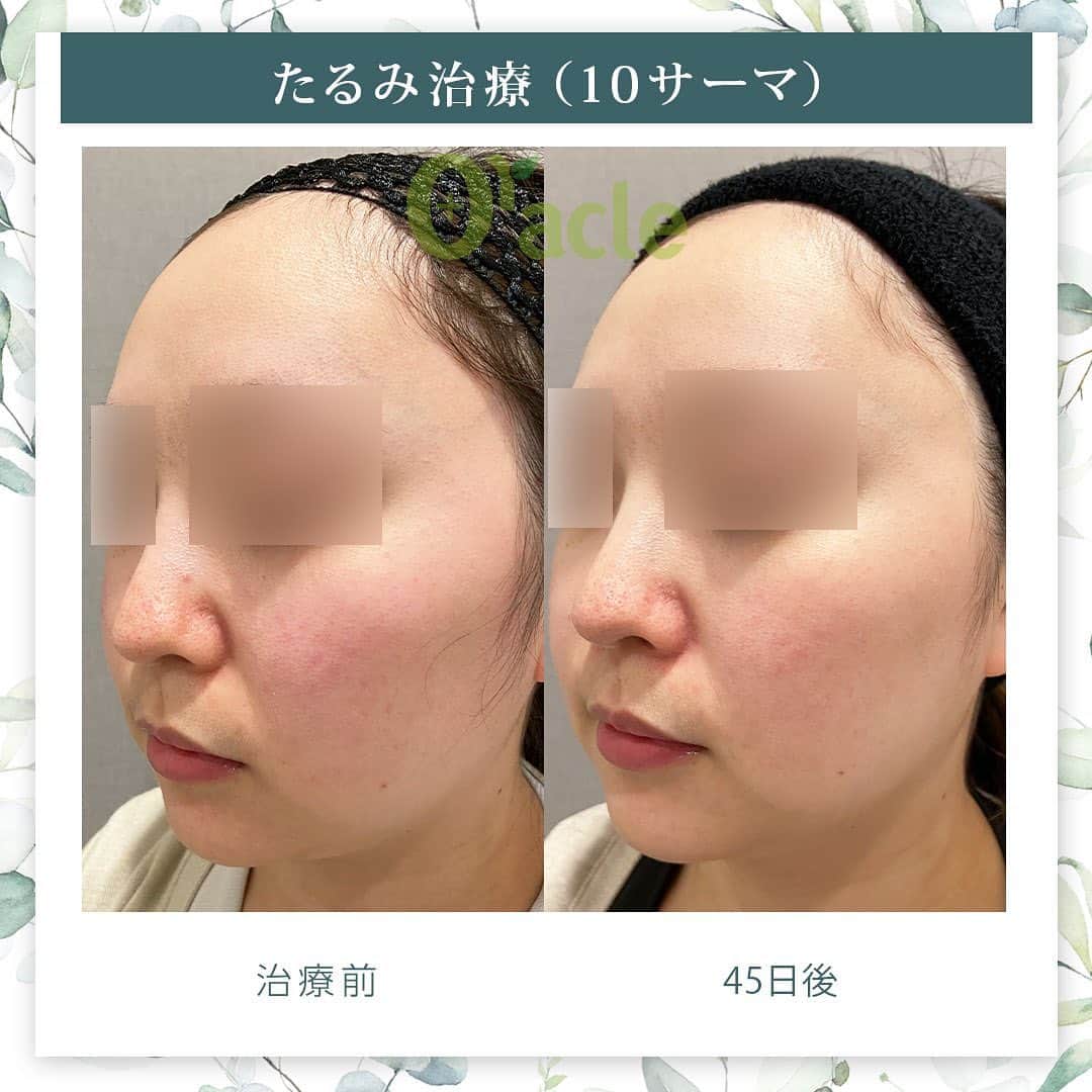 オラクル美容皮膚科東京新宿院さんのインスタグラム写真 - (オラクル美容皮膚科東京新宿院Instagram)「|◤高周波によるたるみ治療症例◢|  《治療内容》 10サーマ（テンサーマ）1回 →45日後経過 →30日後の肌診断（VISIA）による測定  ☑️10サーマ 治療目的▶ 顔の脂肪縮小 肌のハリ フェイスラインやほうれい線のたるみ改善  モノポーラ式高周波を用いた引き締め治療。 ●韓国のMFDS承認機器 ※日本の厚生労働省にあたる機関 ●各種特許取得  🇰🇷韓国では2022年11月にリリースの最新機種 韓国では高周波が人気で、韓国国内外で130以上のクリニックに導入されています。  【ダウンタイム】▶︎ほぼありません 赤み：ほぼなし、出ても数時間から1日程度 洗顔、メイクは当日から◎ ⁡ 【料金】新宿院先行導入 200shot 88,000円（気になる部分） 400shot 165,000円（全顔） 600shot 220,000円（全顔＋顎下） ※全て税込  #10THEMA #10ソマ #高周波 #引き締め #たるみ #弾力 #韓国 #美容 #フェイスライン #ほうれい線 #美容皮膚科 #アンチエイジング #韓国好きな人と繋がりたい #韓国情報  #たるみ改善 #若返り #顔痩せ」3月30日 17時02分 - oraclejp