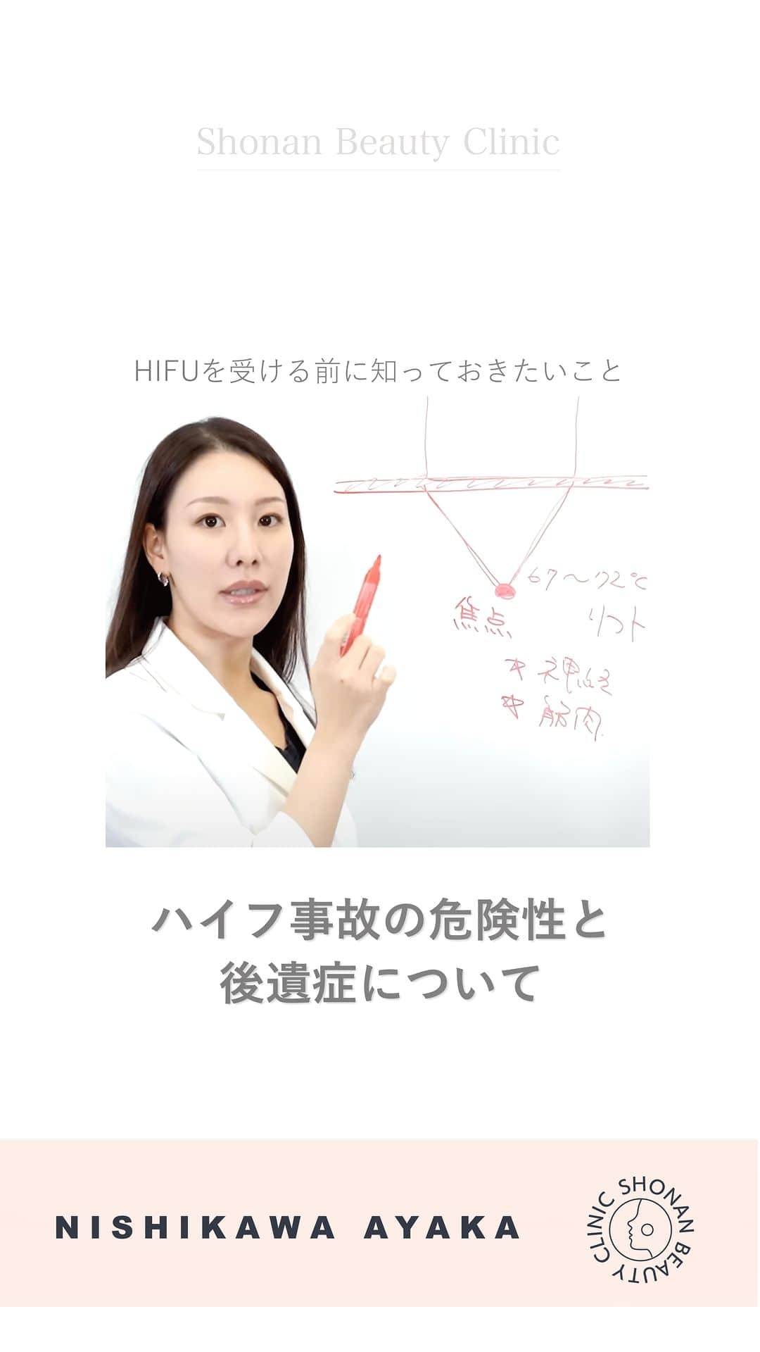 のインスタグラム：「湘南美容クリニックでは導入機器の品質を徹底的に検証し一定の安全性を確認したうえで機械を導入しています。  湘南美容クリニックのハイフは、リスクのある領域への照射を避け、安全面を担保したうえで定めた組織への３層照射を行います。 ウルトラセルQ+やウルセラという医療用ハイフを採用しており、安全性だけではなく効果をしっかりと感じていただけるよう、従来のダブル照射(3.0mm/4.5mm)に加え、SBCハイフシャワー（2.0mm）を同日照射します。　  ウルトラリフトシリーズのハイフ施術件数は累計で470,595件を超え（2023年2月末現在） 多くのお客様に【安全性と効果満足度】ともにご支持頂いている、実績ある治療です。特に、2020年9月に「ウルトラリフトプラスHIFU」がスタートしてから、2023年の2月末迄で35万件を超え、さらに多くのお客様にお受け頂いています。  HIFU機器は本来ガン治療にも使われていた医療機器です。 エステ用に出力を落としたエステハイフ機器でさえも、トラブルが起こることもあり国民生活センターなどへの相談も増えています。 医療機関のHIFU機器は当然ながら出力も高く、医療機関で医師の管理のもとにのみ使用できます。HIFU治療は信頼できる医療機関で行うことをおすすめいたします。  本編はYoutube ◆西川礼華医師の10歳若返りチャンネル /10yearsback 10イヤーズバック◆ https://www.youtube.com/watch?app=desktop&v=wX0v-JLWty0 ◆出演者【湘南美容クリニック】西川礼華医師　皮膚科全体統括 兼 皮膚科経営戦略室室長  ———————————  ▼湘南美容クリニックのハイフ ウルトラリフトプラスHIFU 💠施術の説明💠 ピンポイントで熱ダメージを与えたコラーゲンが縮むことで、たるみを改善する治療です。 💠施術の副作用(リスク)💠 発赤・熱感・痒み・痛み・乾燥を生じる可能性があります。 💠施術の価格💠 24,000円～39,800円  #HIFU #ハイフ   #美容皮膚科　#10歳若返り　#スキンケア　#西川礼華 #ayakanishikawa」