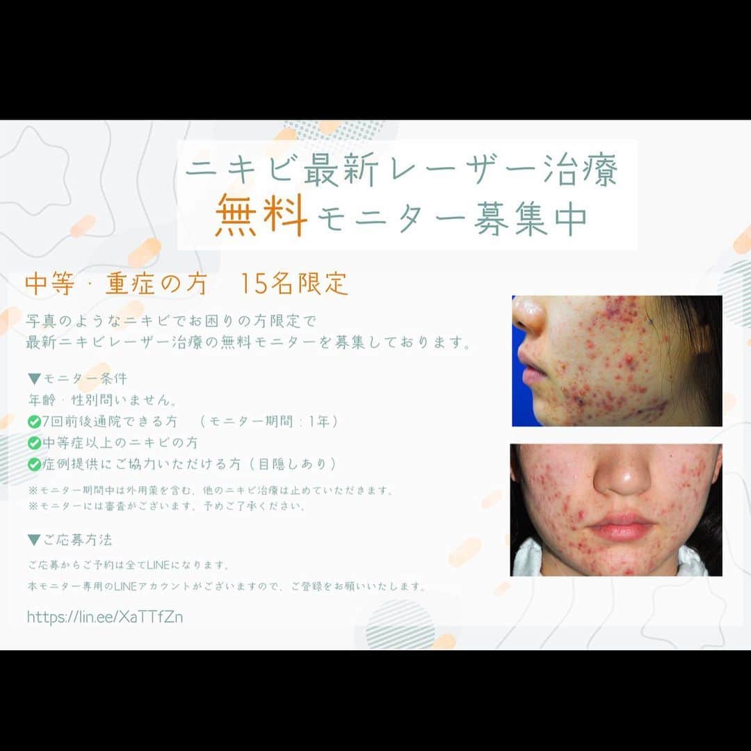 のインスタグラム：「📢ニキビ最新レーザー治療 「無料モニター募集中」  【15名限定】中等・重症ニキビでお悩みの方  東京イセアクリニックでは 最新のレーザー治療機を使用したニキビ治療の無料モニターを募集しています✨  ご応募は以下のモニター専用LINEからお願いいたします😊 （ご応募からご予約は全てLINEになります。 本モニター専用のLINEアカウントがございますので、ご登録をお願いいたします。） ▼ https://lin.ee/XaTTfZn  ▼モニター条件 年齢・性別問いません。  ・7回前後通院できる方(モニター期間：1年) ・中等症以上のニキビの方 ・症例提供にご協力いただける方（目隠しあり）  ※モニター期間中は外用薬を含む、他のニキビ治療は止めていただきます。 ※モニターには審査がございます。予めご了承ください。  #ニキビ　#ニキビケア  #ニキビ肌  #ニキビ改善  #ニキビ治療  #ニキビ皮膚科  #ニキビ対策  #美容皮膚科　#モニター募集」