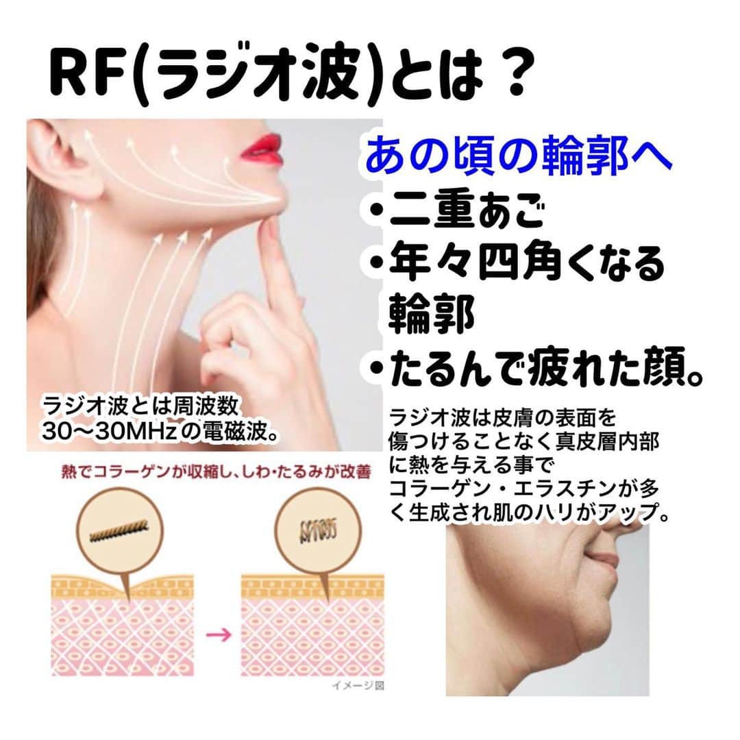 化粧品子さんのインスタグラム写真 - (化粧品子Instagram)「たるみは美顔器！マスク外してドヤ顔に。フェイスラインや目の下に。針を使わない水光注射ララルーチュRFの 秘密とは？ 4月9日日まで限定。 📍定期なし5千円オフ   クーポン出てました！ 今回は分割も5千円オフ！  くわしくはストーリーへ👇 @keshouhinko1225   おうちで美容施術級ケア。 10万円の価値の美顔器。 しかも出力が他の美顔器と比べて高いのにビリビリしない。  7つの機能の中のオススメに エレクトロポレーションがあります。 【エレクトロポレーションとは？】 イオン導入と同じように 電気の力で美容成分を高浸透が 出来ますが圧倒的な違いは美容成分を イオン化させて浸透させるのではなく、 エレクトロポレーションは肌の 細胞間に隙間を作って美容成分を 浸透させる機能です。  元々は、医療用として開発され、注射で直接成分を与えるよりもリスクも 手間も少なく、肌に傷をつけずに 成分を高浸透させることができます。  手やコットンで化粧水や美容液を 塗るよりも、美容有効成分の浸透率は 約130倍と言われています。  真っ赤にならない、ダウンタイム不要で当てるだけの水光注射といわれています。  エステや美容皮膚科で受ける エレクトロポレーション施術は、 1回5,000円〜1万円前後で、 効果を持続させるためには何度も受けなければいけません。  そう考えたら、美顔器購入後は化粧品を買えばいいだけ、スイッチを入れたらいいだけのララルーチュは時間のない女性に嬉しいし、美顔器としてかなりおトクです。首の側面の肩コリも解消されて、めちゃくちゃ気持ちいいです。  ララルーチュは エレクトロポレーションの他に  表情筋を鍛えるEMSや コラーゲン繊維に働きかけるラジオ波、 光の効果で肌を整えるLED、 エステと、5つの機能が同時に使える便利な美顔器です。 1回の使用がたったの5分と短時間なので、忙しい方にもうれしいし、続けやすい！  週に2、3回の使用で たるみやしわ、乾燥、くすみ、シミと 年齢トラブルを総合的にケアできます！ 美顔器本体は、卵1個分の重さなので、 片手でケアしても手が疲れません。   【ラジオ波とは？】 ラジオや無線と同じ周波数帯域のため、 ラジオ波と呼ばれます。 下記の効果が期待できます。  コラーゲンやエラスチンを増やす効果 たるんでしまった コラーゲン線維を引き締める効果  引き締まることによるリフトアップ 二重あごスッキリ 毛穴の引き締め効果 小顔効果  ラジオ波の熱で 体内でヒート・ショック・ プロテインという タンパク質の量が増えます。  真皮のコラーゲンやエラスチンを活性化させ、肌にハリとツヤを与えます。 また、余分な脂肪を燃焼する効果も 小じわの改善や たるんだフェイスラインを キュッとリフトアップ 頬の位置や、目の高さ、口角の位置が 上がる効果が期待できます！ ほうれい線の改善も期待できます。  #美顔器 #ララルーチュ #美顔器効果 #美顔器マニア #美顔器ランキング #ラジオ波フェイシャル #エレクトロポレーション #ems #表情筋 #ほうれい線改善 #目の下のたるみ」4月7日 17時44分 - keshouhinko1225