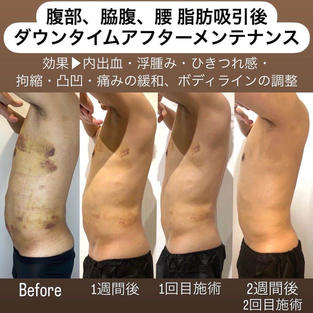 角森脩平のインスタグラム：「. 僕の脂肪吸引の症例写真🤗 KADOMORIはダウンタイム施術を得意としてたので自分自身の身体を実験台に😁 主治医はモッズクリニックの長野先生 @nagano_modsclinic  完璧なオペをいち早く回復させる為に🤗 #モッズクリニック#脂肪吸引#KADOMORI#カドモリ#ダウンタイム #美容整形#ダウンタイム施術#アフターメンテナンス#術後拘縮#超回復」