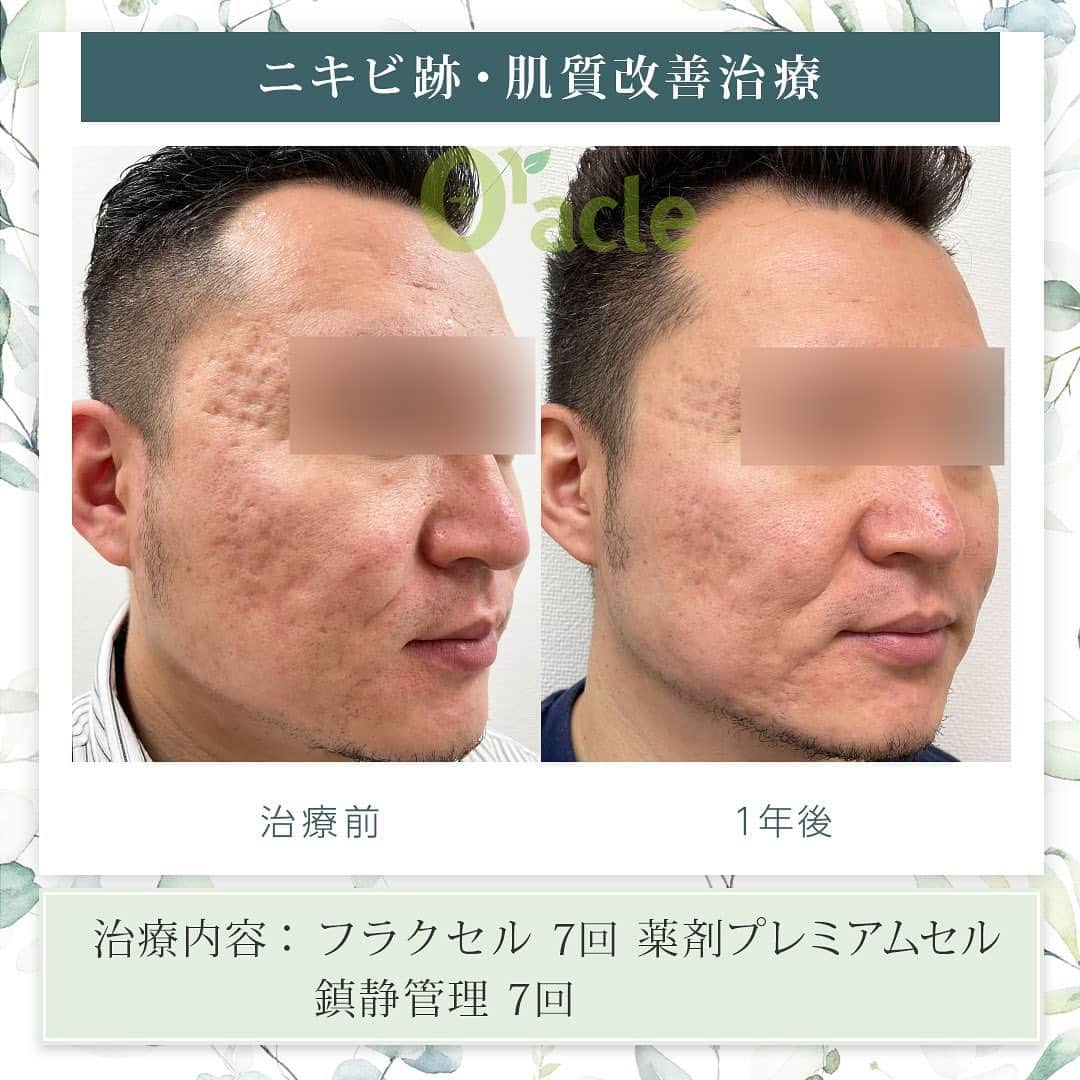 オラクル美容皮膚科東京新宿院さんのインスタグラム写真 - (オラクル美容皮膚科東京新宿院Instagram)「|◤ニキビ跡（クレーター）治療症例◢|  《治療内容》 フラクセル7回 鎮静管理7回  ☑️フラクセル 1回の治療でお肌の5〜15%を入れ替えるレーザー治療  【ダウンタイム】 赤み：2〜10日 浮腫み：出る方もいる 皮剥け：5〜7日 洗顔、メイクは翌日以降 ⁡ 【料金】※税込み ▶︎フラクセル1回19,800円 麻酔代2,200円  ▶︎鎮静管理　1回11,000円 フラクセル後はお肌に熱がこもった状態になります。マイナス15度で冷やしながら鎮静保湿成分を導入する韓国式の治療です。 ⁡ #ニキビ跡 #ニキビ跡治療 #フラクショナルレーザー #ニキビ皮膚科 #皮膚科 #美肌 #メンズ美容　#美肌男子 #美容男子 #美容男子と繋がりたい」4月8日 19時26分 - oraclejp