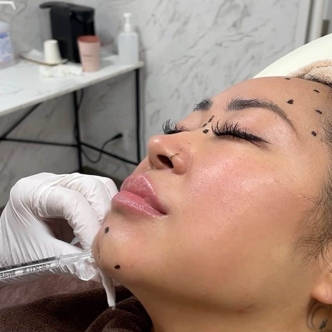 ルナさんのインスタグラム写真 - (ルナInstagram)「久しぶりの @misa.clinic にmaintenance駆け込み寺🏥  その様子をYouTubeにアップしたよ✅  マスクから解放され初の顎ヒアルロン酸+ボトックスでEラインからフェイスラインを整えてきました！ 初めて知った本物のヒアルロン酸と偽物があるなんて！ 皆様、興味ある方は㊙️  カウンセリングでは相変わらず @dr.misae_t 先生に攻め聞きしてますw」4月8日 20時22分 - luna67