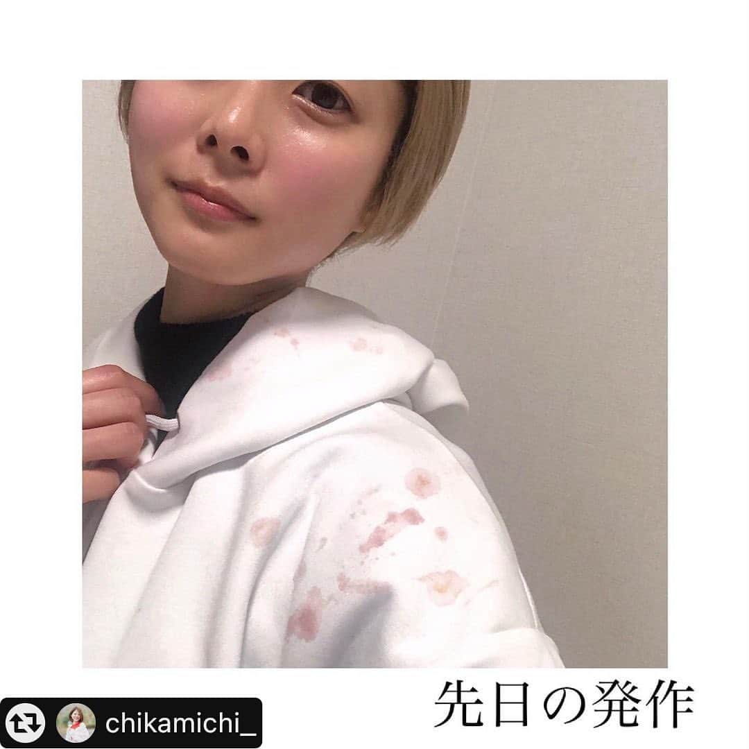 竹内沙帆さんのインスタグラム写真 - (竹内沙帆Instagram)「#リポスト - @chikamichi_ by @get_multi_repost : 【先日の発作】 3月26日 19:00ごろ(？) パープルデー大阪終了後、 "てんかんズー" 打上中に全般発作。 1分くらいだったそう。。  発作時に舌を噛んでしまい。 真っ白なパーカーが赤く染まりました🫠笑  ゆきちゃんとやまゆりさんが対応してくれた上、 てんかん専門の岡崎先生、河田さん、猪股さんが 駆けつけてくださったおかげで大事至らず😂  無事に終わった安堵感が大きかったのかな💭 時間も休憩も忘れるほど楽しかったし♡笑  もうひとつあるとしたら薬の飲み忘れかけ👀 18:30ごろから何度か1〜2秒の部分発作があって。。 薬を飲んでいないことを思い出し、 少し遅めの時間ながら慌てて飲んだところでした🌿 (日常でも遅れて飲むこと結構あるんだけどね😂)  色々と心体バランスの乱れが 重なったタイミングだったのかも。  自己管理！ 改めて自分にも言い聞かせる意味での投稿🫧  ------------------------------------ 病気、トラウマ、コンプレックスで 悩む方々に喜びときっかけを🌱 ☞@chikamichi_  *\☺︎/* にこにこ配信中 *\☺︎/* ------------------------------------  #てんかん#てんかん発作#てんかん持ち#てんかん治療中#脳神経外科#自律神経ケア#小児てんかん#ウエスト症候群#食事療法#ケトジェニック女子#ケトン食#予防栄養学アドバイザー#パレオダイエット#パープルデー大阪#パープルデー#ヘルプマーク#purpledayosaka #purpleday #purpledayeveryday」4月9日 6時46分 - purpledayosaka