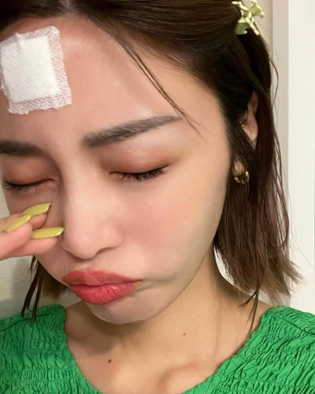 島袋聖南のインスタグラム：「子供の頭って重いですねー🥲 寝ている時に不意打ち頭突きされまして しかも同じかしょを2回も、、 アオブダイになってしまった🐟🪸 今は結構腫れが落ち着いたけど、まじでツノが生えるんじゃないかと思うほど一時は赤く腫れ上がっていたので心配でした😭 冷えピタとサングラスかけて街を歩いている不審者は私ですw #息子は怪我なくぴんぴんしてます♡」