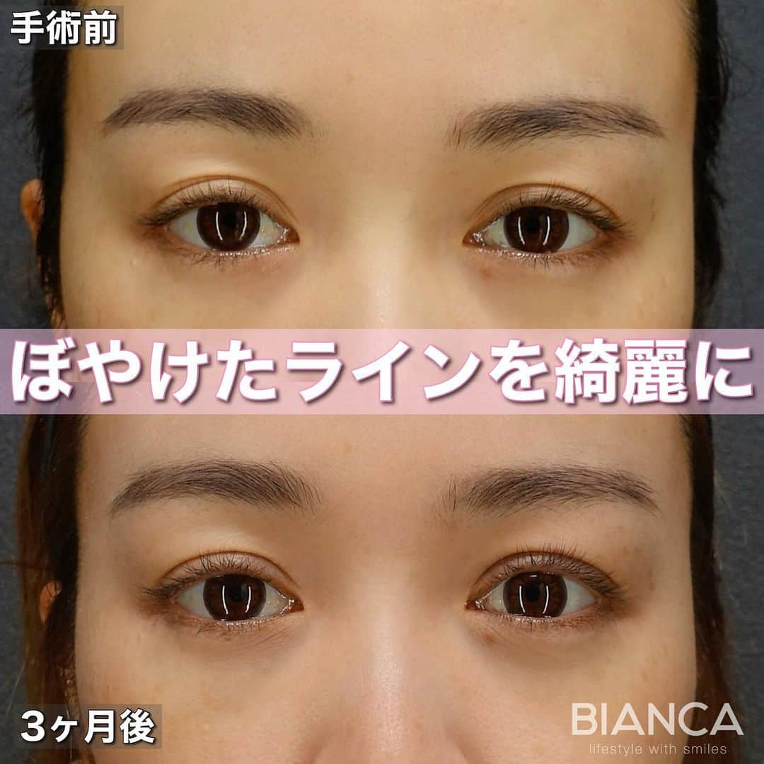 辻沢由有（BIANCA CLNIC 表参道院 院長）さんのインスタグラム写真 - (辻沢由有（BIANCA CLNIC 表参道院 院長）Instagram)「#dryuu目　#dryuu二重  ▶︎swipeで文字なし&別角度症例写真▶︎  二重の幅は広めのままご希望で、眠たそうなお目元の改善&ぼやけているラインをMT法で綺麗にしました🫧  上　術前 下　術後3か月  MT法は、特殊な極細⽷でまぶたの裏側の筋⾁を縫い縮めることで⽬の開きを良くする⼿術です。  🌸瞼の開きが悪く⿊⽬が隠れる 🌸眠そうに⾒える 🌸⽬つきが悪いと⾔われる  現在、お得なモニター様も募集しています。 私も適応かも？と思った方は、 一度ぜひカウンセリングにお越しください✨  💉眼瞼下垂（MT法） 💴税込365,580円 😷腫れ 内出血:数日〜1週間程度  *⑅୨୧ ----------------------- ୨୧⑅*  お肌•注入•お手術まで全て担当できます🥰 「何をして良いかわからない」 「ガッツリ変わりたい」「自然な変化が良い」etc...なんでもご相談ください✨  📝ご予約はwebが便利です✨ プロフィール欄のリンクからご予約ください。 ※医師指名可能（“大久保医師指名”をクリック） ※診察料はかかりません🙅‍♀️ ※表参道院勤務が9割となっています。  📍BIANCA CLINIC ※お電話頂くと自動音声通話に繋がります。 ✔︎表参道院 ☎️05018071593 東京都港区南青山5-11-10  南青山511ビル 2F ✔︎銀座院 ☎️05031964834 東京都中央区銀座1-8-19 キラリトギンザ12F  •診療時間 10:00〜19:00 •年中無休（年末年始を除く）   #二重切開 #二重埋没 #二重整形 #埋没法#二重埋没法 #タッキング #切らない眼瞼下垂症手術 #切らない眼瞼下垂 #MT法 #眼瞼下垂手術 #眼瞼下垂 #くぼみ目 #くぼみ目改善」5月5日 11時45分 - i_am_yuu__