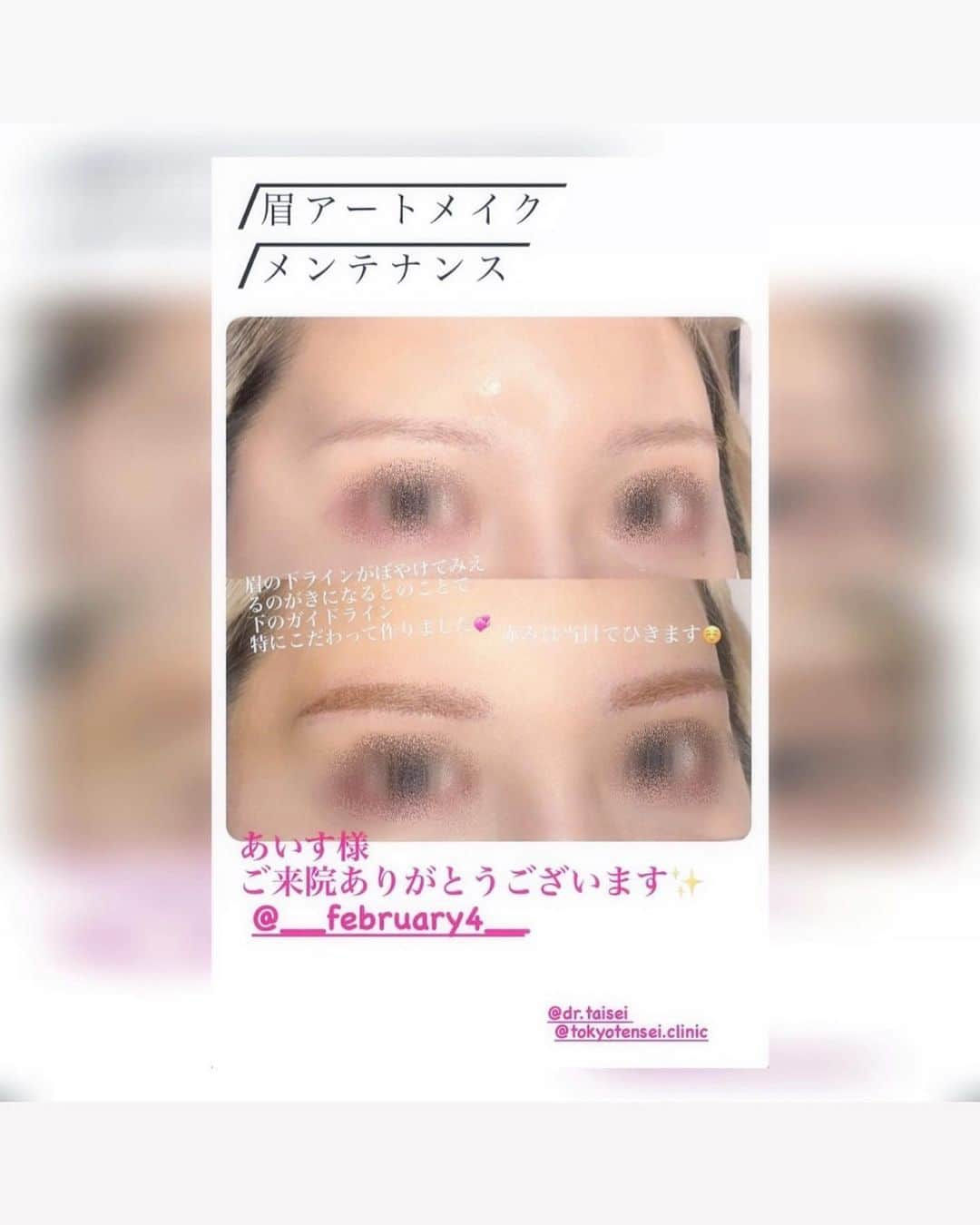 Aiceさんのインスタグラム写真 - (AiceInstagram)「✎𓂃 𝐸𝑦𝑒𝑏𝑟𝑜𝑤 𝐴𝑟𝑡𝑚𝑎𝑘𝑒  @tokyotensei.clinic のたいせい先生のご紹介で眉のアートメイクを @miyu_medicalartmake にしていただきました！  先ずは一言“めちゃくちゃ丁寧で上手い”です。  数年前に何度かした事があったのですが、担当の方が退職されそれを機に疎遠になっていたアートメイク。 わたしは過去に眉下切開をしており、左右対称に描いてるつもりでも傷跡と骨格で非対称に見えるという悩みを瞬時に汲み取ってくださり施術前も途中も何度もバランスを見て調整していただきました ✍︎ ｶｷｶｷ 下ラインを重点的にやってもらいずっとぼやけていた眉が綺麗になった…これ自分じゃ限界があるので本当に嬉しいんです。Before / After見て眉毛って本当に大事なパーツだなぁと再確認しました  仕上がり直後は野原しんのすけみたいになるイメージが強かったので覚悟していたのですが今回髪が明るいこともあり色味も馴染むようにしてもらったからちょー自然！ 1.2枚目の写真は眉マスカラのみ。デザインは元の眉の形に沿った並行っぽい感じ。どの角度から見ても第三者から見て綺麗なのが理想的 ✧   皆が気になる痛さはというと、塗る麻酔をするからへっちゃらどころかわたしは終盤気がついたら眠ってました（笑）  担当してくださったMIYUさんはめちゃくちゃ小顔で目がくりっくりでお人形さんみたいな容姿で目が合う度ドキッとしてしまった…… 公式ラインにはお得な30%offクーポンがあるみたいなので気になってる方は是非ゲットしてみてね 🎫🔥 🔗 https://page.line.me/515sdayi  ┈  カラコンは引き続きrainのネモフィラ 💠 外でも室内でも高発色…くりくりおめめになれる  ・ ・ ・  #東京転生クリニック #眉アートメイク #アートメイク眉 #眉下切開 #アートメイク #rain #rainネモフィラ #水色カラコン #日暮里ダージリン #シースルー前髪 #ハイトーンボブ #自まつ毛メイク #ドーリーメイク」5月6日 20時45分 - __february4__