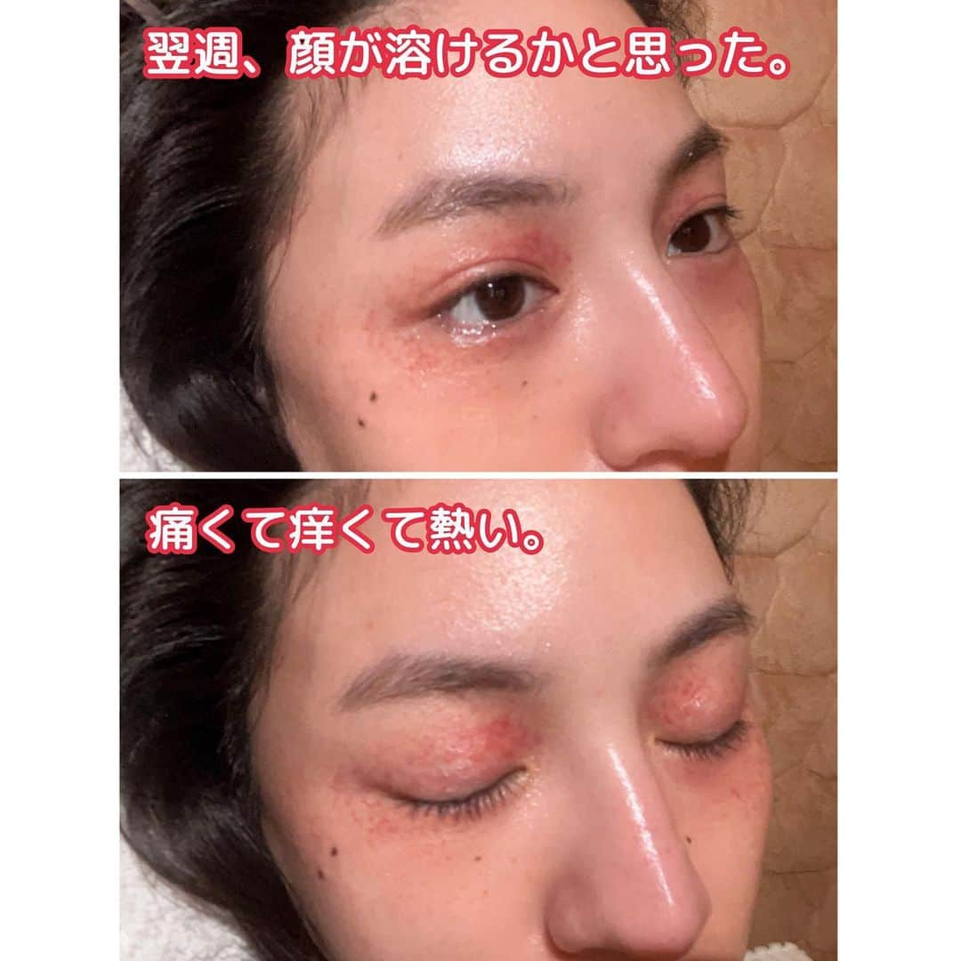 立花陽香さんのインスタグラム写真 - (立花陽香Instagram)「一ヶ月、殆ど寝込んでいる為🫠🫠🫠お久しぶりになりました。  ただの皮膚炎かと思って皮膚科へ行ったら、すぐに内科の検査を勧められ👉血液検査とアレルギー検査👉その後、精密検査をすることになり👉免疫疾患🧬による聞いたこともない名前の難病がみつかり（免疫が正常に機能しなくなり、自分で自分の身体の組織を攻撃してしまう病気）体内に炎症が起こっていないか腎臓の精密検査👉現在は投薬治療をしています。 悪化する可能性はありますが、今のところ人工透析やステロイド投与までは至らず、最悪な状態ではなかったです。 すぐに病院へ行く大袈裟な性格のお陰で、早期発見できました。❤️‍🔥❤️‍🔥❤️‍🔥❤️‍🔥 家族が同類種の病気をしていることもあり遺伝性が高いとのことでしたが、私が偏食なことから栄養失調の症状が多くみられ、身体が弱って発症してしまったものだと思います。 身体に栄養が足りなくなると、まず内臓に栄養がいくように体内が優先されるもので、皮膚や爪や髪は後。私の場合はまず全身の肌バリア機能がブッ壊れてアレルギーじゃないものにも反応を起こしました。薬品パッチテストをして、肌に触れる日用品をセンシティブなものに買い換えたので、またpostします✍️かなり敏感肌で神経質になっています。 幹細胞培養上清液や臍帯血上体液の細胞治療も加え、炎症が起きていた皮膚も再生し、体重も増えて、現在は倦怠感を伴う微熱程度で体調は安定しています。 不調の時は連日寝込んでしまいますが、動ける日もあるので少しずつ🤏仕事をして、体調が良い日が続いたら遊びにも行きたい。  みんな、病気しないようにちゃんとご飯を食べていっぱい栄養を摂って健康でいてね。🍙🍙🍙 30歳を過ぎたら保険の見直しをしてね。  DM✉️で沢山の励ましの言葉を頂いたこと、心配してくれたお友達や兄さん達の存在がとっても嬉しかったです。一言だけでも📞本当に本当に嬉しかった。お家と病院で大人しくするのは寂しいもので、この尊さは病気をしたから尚更分かったこと。」5月7日 21時53分 - haruka_4