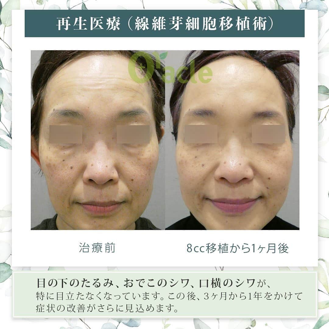 オラクル美容皮膚科東京新宿院さんのインスタグラム写真 - (オラクル美容皮膚科東京新宿院Instagram)「◤ 肌の再生医療（セルバンク） ◢| ※当院の再生医療は北條元治先生の自家培養真皮線維芽細胞移植です。  🩺現在は新宿院の古市院長のみ再生医療を担当しております。  《治療内容》 8CC 移植 ※移植回数は4CC×2回 ※特に目の下のたるみ、口横のシワが良くなっております。 ※3ヶ月以降さらに効果が現れます。  気になる箇所は手打ちで、お顔全体は機械で移植します。  《治療内容の詳細》 日焼けなどのダメージの少ない耳の裏から皮膚を採取し、（米粒～小さじ一杯分程度の大きさ） その皮膚から細胞を取り出し専用の施設で培養し10,000倍に細胞の数を増やし 増やした細胞をもう一度お肌に戻す再生医療です。 細胞が増えることでお肌にハリや潤いを与えお肌全体を若返らせる治療です。  ⚠️副作用・リスク等 ご自身の細胞のため副作用は極めて低いですが 一般的な医療行為と同じように内出血、色素沈着の可能性があります。  【料金】 セルバンクの初診料​	5,500円 血液検査​	11,000円 細胞採取・培養	　495,000円 初回移植1回目（1ccの場合）	151,800円 初回移植2回目（1ccの場合）	151,800円  【移植料金】 1cc 151,800円 2cc 303,600円 3cc 455,400円 4cc 607,200円  上記の他、細胞を保管する場合 細胞保管料：11,000円／月  🉐モニタープラン（Aプラン、Bプラン、Cプラン）のご用意もございます。  詳しくはオラクル美容皮膚科公式サイトにてご確認お願い致します。  #再生医療 #肌の再生医療 #セルバンク #北條先生　#北條元治  #若返り #アンチエイジング #ほうれい線 #たるみ」5月8日 12時20分 - oraclejp
