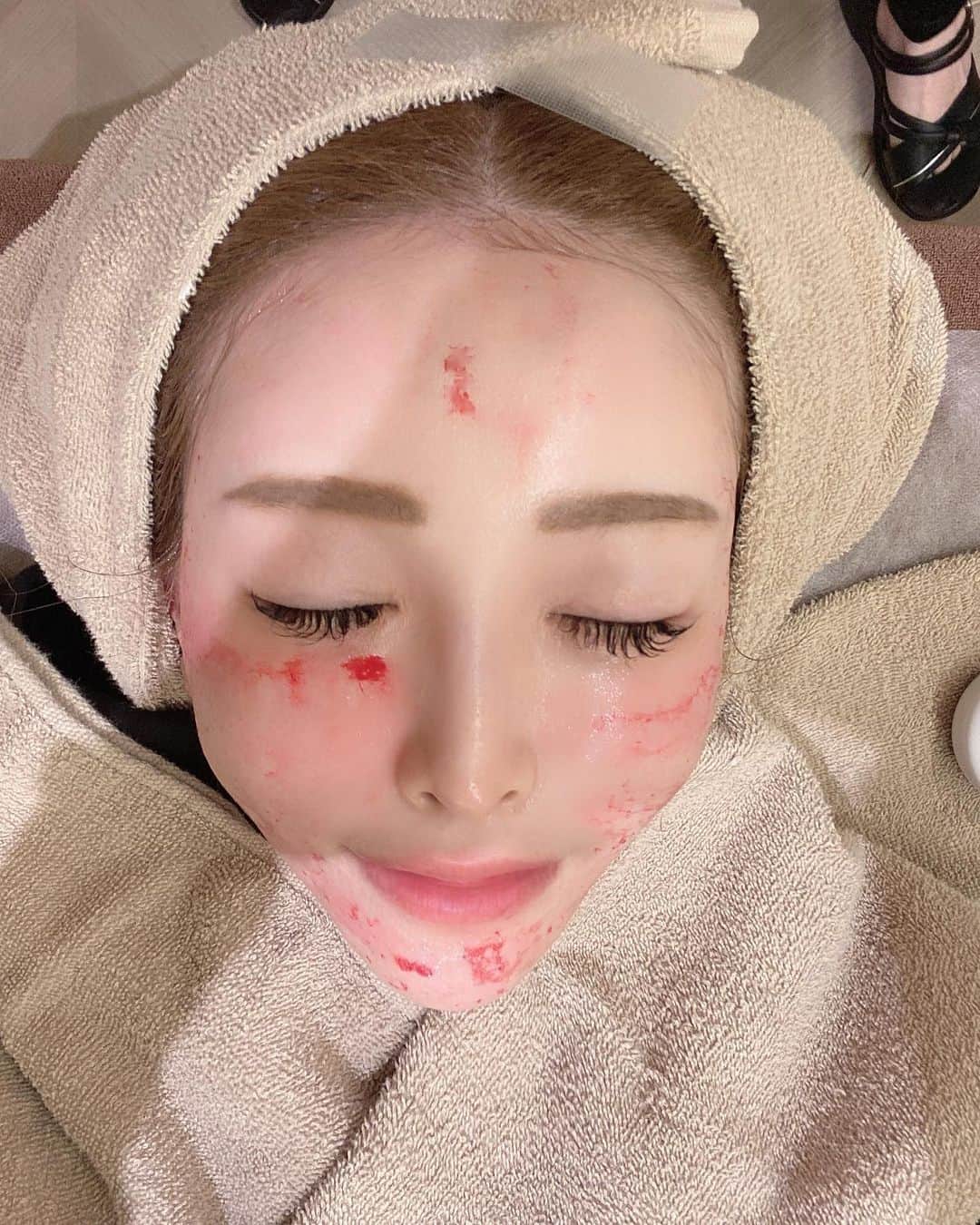 MARIKOさんのインスタグラム写真 - (MARIKOInstagram)「. . @lifix_beauty_clinic  で今日は首のマッサージピール受けました✨年齢と共に首の線気になってて施術受けたよ♡ この前は、水光注射💉受けたんやけど、ツヤ感も出るし水光注射オススメ✨ 次回脱毛お願いします♡  クリニックの雰囲気もいいし、綺麗でオシャレ感出てるしビルにカフェやジムも入ってるから 1日ゆっくり過ごせそー🤭💕 看護婦さん、スタッフさん達もいい人ばっかりでいつもありがとうございます🥰オススメのクリニックです🏥💕 . . . . . . #美容クリニック  #水光注射 #マッサージピール #美容好きな人と繋がりたい」4月14日 20時07分 - marichi.1010