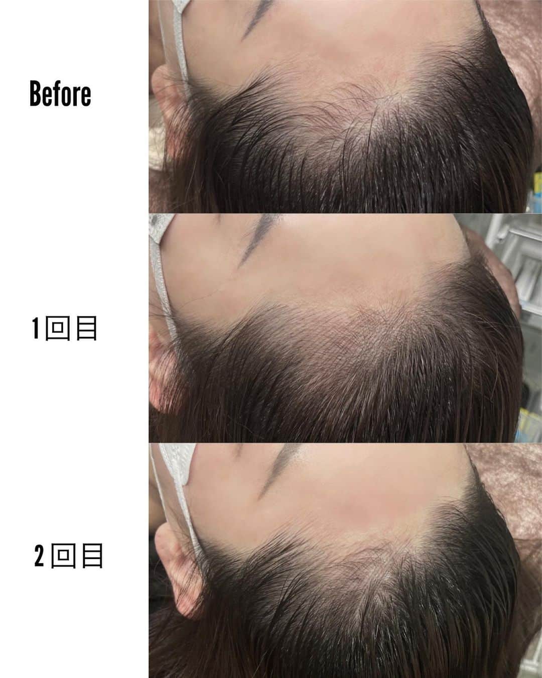 山崎みどりさんのインスタグラム写真 - (山崎みどりInstagram)「業界シェアNo.1のメディカルブローで ヘアラインのアートメイクをしてきたよ🤍　@medicalbrows   2回セットで完成だから 今回は2回目で行ってきた♡  そもそもなんでヘアラインアートメイクをしたいと思ったかというと.. 生まれつき左の前髪につむじがあって つむじのところが毛が薄いから ヘアラインに左右差があるのが気になっていつもアイシャドウで左右均等にしてたのが悩みだったから。  でも今回先生におでこのヘアラインのゴールデン比率をデザインしてもらって、 一本一本手書きでヘアラインを入れてもらった♡  気になってたおでこにあるつむじの薄い所はおでこのラインが左右対象になって生え際が綺麗になって小顔効果もあって本当に最高✨  こんなに変わるならもっと早くやれば良かった🥲  美容室の担当の人にヘアラインアートメイクの事を伝えてみたら 「え、言われてもわからない..😳この方上手ですね‼︎」と驚いてたほどw  痛みについては 麻酔クリーム塗って麻痺させて、 その後アートメイクスタート。 最初はチクーっくらい。 その後また麻酔を追加してくれてるから、全然痛く無い。 無痛過ぎて寝てた😴くらい  クリニックは @medicalbrows_keyaki  ヘアラインアートメイクの担当していただいたのは @medicalbrows_sato さん  おでこのラインが気になる人には本当オススメ♡  ────────────────────────── #メディカルブロー #アートメイク #ヘアラインアートメイク #メディカルアートメイク #ヘアライン #時短メイク #医療アートメイク #メディカルブローしてきた」4月14日 13時21分 - midori_yamasaki_