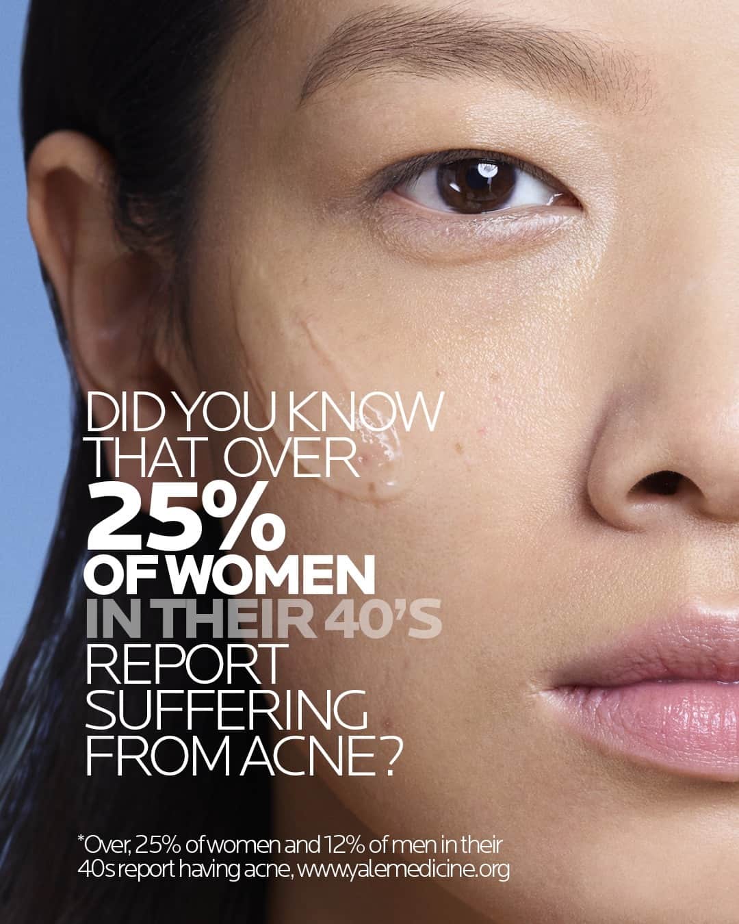 La Roche-Posayのインスタグラム：「The struggle is real when you don’t feel good in your skin.  Time to soothe the mind and heal the skin with Effaclar Serum.   📉 A 40% decrease in acne imperfections ⚡️ Visible results within 2 months  👩‍👧 Efficient on both adolescent and adult skin   Do you already use an EFFACLAR solution? Share your story with us below 💬  All languages spoken here! Feel free to talk to us at anytime. #larocheposay #effaclar #acne #marks #acneproneskin #imperfections  Global official page from La Roche-Posay, France.」