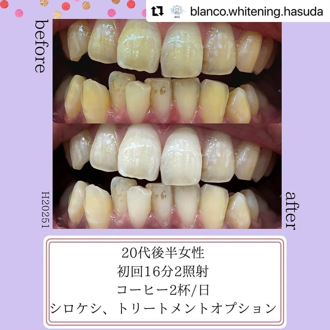 30DAYSホワイトニングキットのインスタグラム：「今回は埼玉県の 歯のホワイトニング　「Blanco(ブランコ)蓮田駅前店（@blanco.whitening.hasuda）」さまをご紹介します💜💗  美歯口AWARD2022のフランチャイズ店舗部門で受賞されていた店舗様です🌟 ぜひ皆さま行ってみてくださいね☺️  🏠お店情報はこちら ⬇️⬇️   ・・・・・・・・・・・・・・・  #Repost @blanco.whitening.hasuda with @use.repost ・・・ ✴︎  こんにちは🦷  ホワイトニングアドバイザーの村上です💁🏼‍♀️✨  【症例写真紹介📸】  初回16分2照射🦷 オプションで 《シロケシ&トリートメント》を使用された お客様の症例写真です☺️🤍  全体的な黄ばみが落ち、トーンアップされました✨  回数券利用で通っていただき、当店のプラチナ歯ブラシを使用されている とても意識の高いお客様です🥰  次回はどれくらいトーンアップするか 楽しみですね🤩  ⁡ ------------------------------------------- ⁡ ⁡ 「歯のホワイトニングBlanco」蓮田駅東口から徒歩3分✨ ⁡ お陰様でオープンから1周年を迎える事ができました🦷✨ ⁡ 駅近・低価格・短時間 お買い物ついでにホワイトニングが可能です🙆🏽‍♀️ ⁡ ⁡ ⁡ 『Blancoのホワイトニングで笑顔がもっと好きになる🤍』 ⁡ staff一同、皆様のご来店を心よりお待ちしております💓 ⁡ ⁡ ⁡ ⁡ ⁡ 【歯のホワイトニング　Blanco(ブランコ)蓮田駅前店】 　 💎〒349-0111 埼玉県蓮田市東5-8-65 東武ストア蓮田マイン2階 TEL📞048-720-8482 ⁡ 💎営業時間 月〜金　11:00〜20:00 土日祝　10:00〜19:00 ⁡ 💎定休日 不定休 ⁡ 💎駐車場あり ⁡ ⁡ ご予約、お問い合わせはプロフィール @blanco.whitening.Hasuda ⁡ URLより24時間承っております🤍 ⁡ ⁡ LINEからでもご予約簡単にお取りできます❕ ID→@409gwocp ⁡」