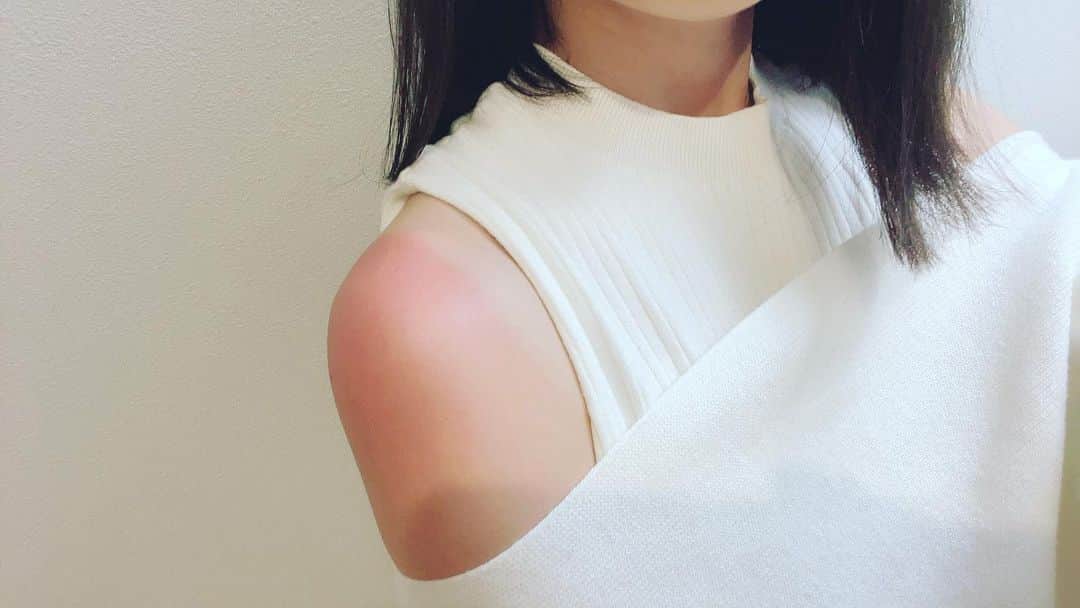 のインスタグラム：「富士スピードウェイ 風が冷たくて寒かったのに…紫外線めちゃくちゃ強かったみたい💦 面白いくらい真っ赤にやけてた😂   #日焼け」
