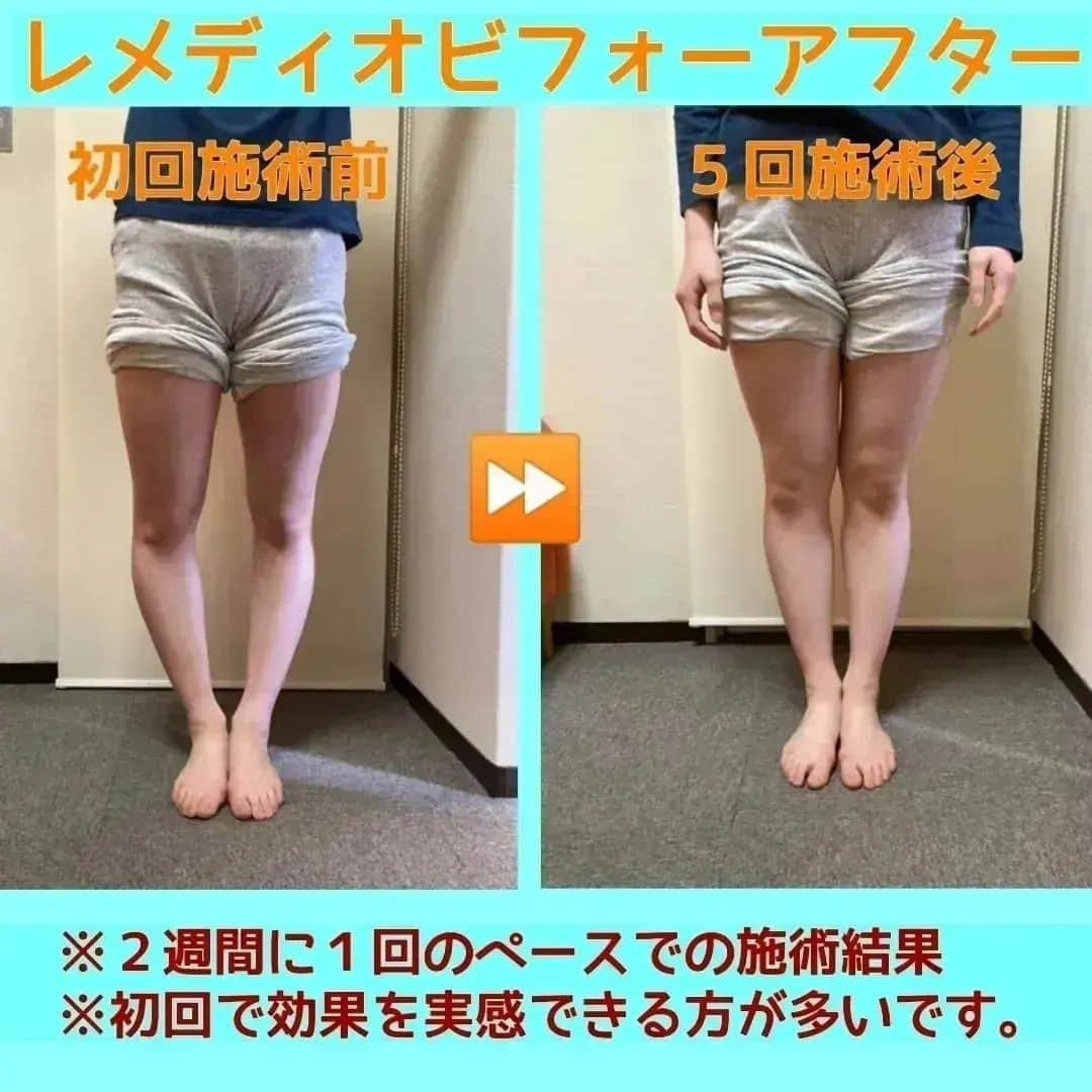 中目黒整体レメディオ 院長　渡邉潤一さんのインスタグラム写真 - (中目黒整体レメディオ 院長　渡邉潤一Instagram)「ふくらはぎが太くなってしまうのは、膝下にある脛骨と腓骨という骨が関係しています。  脛骨と腓骨のゆがみ方は、非常に分かりにくい動きをします。ここでは、分かりやすいように簡略化して説明していきます。  まず、ふくらはぎが膨らんでいる方の場合、股関節や太ももの骨（大腿骨）は内側にねじれるような形でゆがみます。  この時、膝寄りの部分では図のように外側に開くよう状態になります。 筋肉の癖としては、斜め後ろに広がるような格好で筋肉が膨らんでいきます。  ふくらはぎにはひふく筋とひらめ筋という筋肉があり、特に内股の癖のある人はこの２つの筋肉のうちのひらめ筋を非常に多く使います。  ひらめ筋は名前の通り、魚のひらめのような形状をしているので、多く使われることで後外側が膨らんでいきます。 この２つが合わさり、ふくらはぎのラインは全体的に外側に膨らんでしまうのです。  また、ふくらはぎの関節がゆがんだことで、膝の後ろを流れる血管を締め付けるので、老廃物は排出されずふくらはぎをむくませます。  マッサージをしても取れないむくみ、細くならないふくらはぎ、その原因は膝下の骨のゆがみが原因かもしれません。 . . ーーーーーーーーーーーーーーーーーーーーー  💮施術のご案内💮 中目黒整体レメディオ：骨盤・美脚コース 施術をご希望の方は、はHPの予約フォームか、 お電話（0357735977）にてご連絡ください。  ーーーーーーーーーーーーーーーーーーーーー  #大転子 #大転子矯正 #o脚矯正 #x脚矯正 #膝下o脚 #XO脚 #骨格矯正 #骨盤矯正 #産後骨盤矯正 #下半身太り #下半身痩せ #太もも痩せ #ふくらはぎ痩せ #反り膝  #反り腰 #骨盤の歪み #整体 #レメディオ #姿勢矯正 #中目黒整体レメディオ #整体サロン #膝下ストレッチ」4月26日 14時23分 - remedio_watanabe