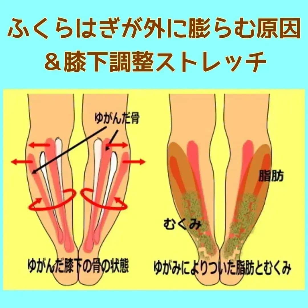 中目黒整体レメディオ 院長　渡邉潤一のインスタグラム：「ふくらはぎが太くなってしまうのは、膝下にある脛骨と腓骨という骨が関係しています。  脛骨と腓骨のゆがみ方は、非常に分かりにくい動きをします。ここでは、分かりやすいように簡略化して説明していきます。  まず、ふくらはぎが膨らんでいる方の場合、股関節や太ももの骨（大腿骨）は内側にねじれるような形でゆがみます。  この時、膝寄りの部分では図のように外側に開くよう状態になります。 筋肉の癖としては、斜め後ろに広がるような格好で筋肉が膨らんでいきます。  ふくらはぎにはひふく筋とひらめ筋という筋肉があり、特に内股の癖のある人はこの２つの筋肉のうちのひらめ筋を非常に多く使います。  ひらめ筋は名前の通り、魚のひらめのような形状をしているので、多く使われることで後外側が膨らんでいきます。 この２つが合わさり、ふくらはぎのラインは全体的に外側に膨らんでしまうのです。  また、ふくらはぎの関節がゆがんだことで、膝の後ろを流れる血管を締め付けるので、老廃物は排出されずふくらはぎをむくませます。  マッサージをしても取れないむくみ、細くならないふくらはぎ、その原因は膝下の骨のゆがみが原因かもしれません。 . . ーーーーーーーーーーーーーーーーーーーーー  💮施術のご案内💮 中目黒整体レメディオ：骨盤・美脚コース 施術をご希望の方は、はHPの予約フォームか、 お電話（0357735977）にてご連絡ください。  ーーーーーーーーーーーーーーーーーーーーー  #大転子 #大転子矯正 #o脚矯正 #x脚矯正 #膝下o脚 #XO脚 #骨格矯正 #骨盤矯正 #産後骨盤矯正 #下半身太り #下半身痩せ #太もも痩せ #ふくらはぎ痩せ #反り膝  #反り腰 #骨盤の歪み #整体 #レメディオ #姿勢矯正 #中目黒整体レメディオ #整体サロン #膝下ストレッチ」