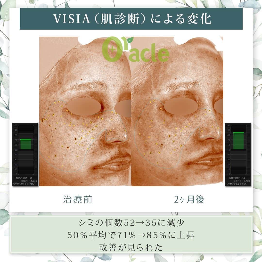 オラクル美容皮膚科東京新宿院さんのインスタグラム写真 - (オラクル美容皮膚科東京新宿院Instagram)「◤薄いシミ治療◢| 《治療内容》10PL 1回 他のレーザーでは反応しなかった方です 薄いシミに反応し改善が見られます  ✨札幌院にも導入します‼︎ 　すでに10PL指名の患者様から多数ご予約いただき嬉しいです✨  ☑️10PL 韓国Oracle統括院長　ノ・ヨンウ医師開発 世界初の技術『フラクショナルIPL』搭載 ➡︎特許取得  安全性 ・韓国MFDS承認機器 ・アメリカFDA承認機器  治療目的：シミそばかすの除去、肌の再生  【ダウンタイム】 赤み：3〜5日 瘡蓋：7〜10日　※テープ保護不要 洗顔：当日 メイク：当日から可能ですが、ひりつきが出ますので翌日から推奨 ⁡ 【料金】 1回38,500円税込（鎮静管理込み）  ※目周りを除く  🉐初回セット 初回セット35,000円税込（鎮静管理込み） オプション：目周り8,800円 ⁡ #シミ #シミ取り　#シミ治療 #シミ取りレーザー #そばかす #10pl #フラクショナルレーザー #IPLレーザー #美肌　#美白 #美容皮膚科 #韓国美容 #韓国クリニック #10PL症例」4月27日 16時44分 - oraclejp