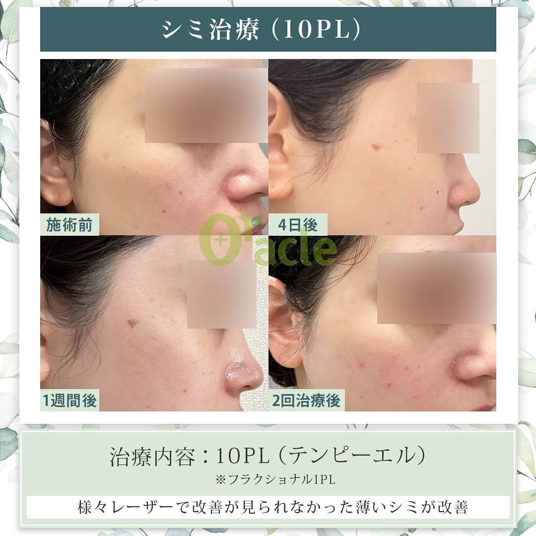 オラクル美容皮膚科東京新宿院さんのインスタグラム写真 - (オラクル美容皮膚科東京新宿院Instagram)「◤薄いシミ治療◢| 《治療内容》10PL 1回 他のレーザーでは反応しなかった方です 薄いシミに反応し改善が見られます  ✨札幌院にも導入します‼︎ 　すでに10PL指名の患者様から多数ご予約いただき嬉しいです✨  ☑️10PL 韓国Oracle統括院長　ノ・ヨンウ医師開発 世界初の技術『フラクショナルIPL』搭載 ➡︎特許取得  安全性 ・韓国MFDS承認機器 ・アメリカFDA承認機器  治療目的：シミそばかすの除去、肌の再生  【ダウンタイム】 赤み：3〜5日 瘡蓋：7〜10日　※テープ保護不要 洗顔：当日 メイク：当日から可能ですが、ひりつきが出ますので翌日から推奨 ⁡ 【料金】 1回38,500円税込（鎮静管理込み）  ※目周りを除く  🉐初回セット 初回セット35,000円税込（鎮静管理込み） オプション：目周り8,800円 ⁡ #シミ #シミ取り　#シミ治療 #シミ取りレーザー #そばかす #10pl #フラクショナルレーザー #IPLレーザー #美肌　#美白 #美容皮膚科 #韓国美容 #韓国クリニック #10PL症例」4月27日 16時44分 - oraclejp