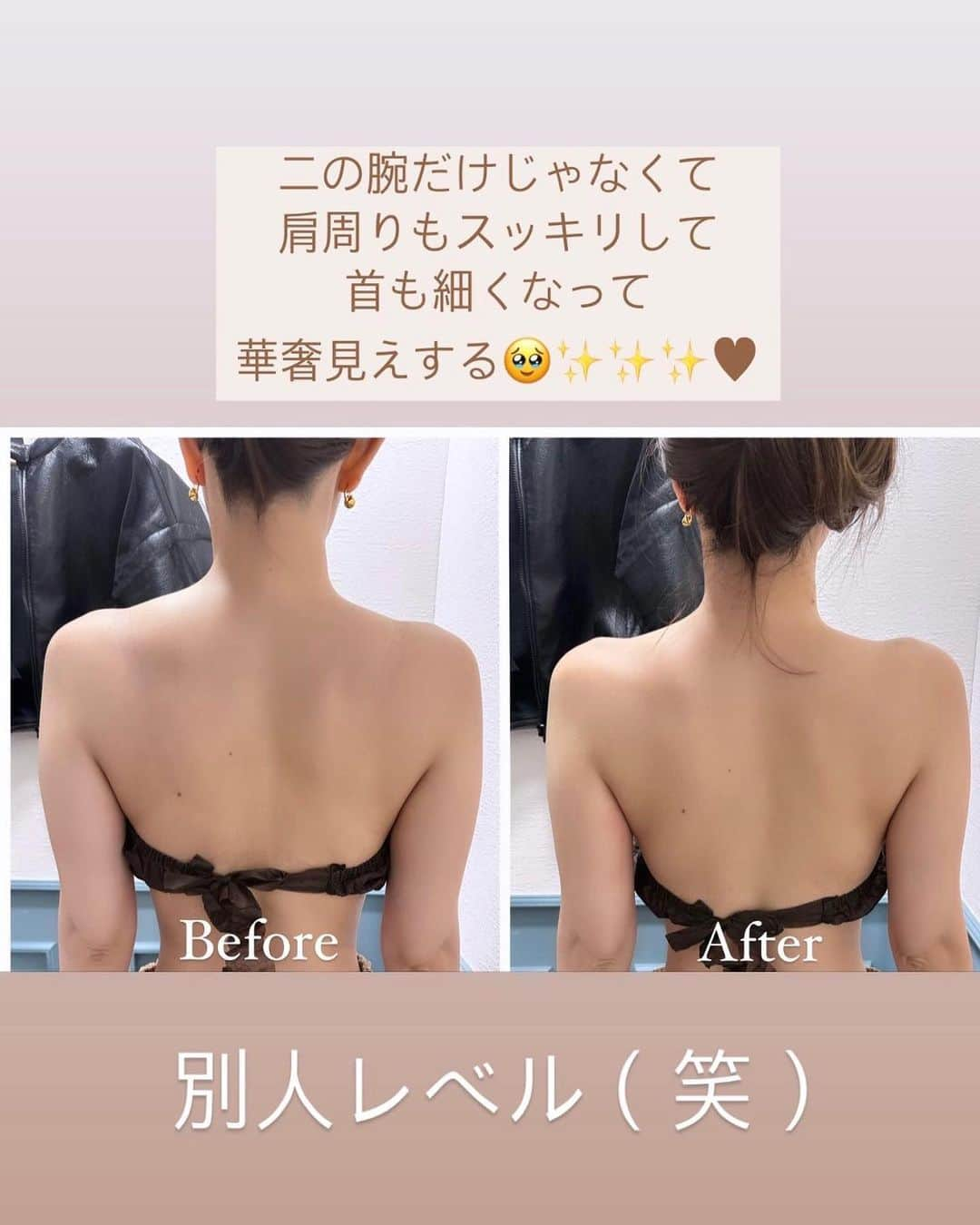 岩下えみさんのインスタグラム写真 - (岩下えみInstagram)「⁡ 今月も @zeal_clinical.salon さんで 二の腕やっつけてもらったよ♥︎😂 ⁡ 今回はグローブでしっかり癒着してる 筋肉をほぐしてもらってから スタート♩( ᐛ) これ肩凝り、首凝りまでめちゃくちゃ 楽になる‼︎😫🫶🏼 常に凝ってて痛いのが普通に なってる事に気付かされる😹🌻 ⁡ からの、ハイフを当ててもらったよ🥰 本当にハイフはどんなにマシンが 良くても当ててもらう人によって 効果が全然違うからちゃんと 見極めが大事だよ🙆🏽‍♀️𖧷 ⁡ 二の腕もスッキリしたけど 後ろ姿がめちゃくちゃ別人🤣 まずBeforeがこんなに逞しくて ショック（笑） 華奢見え♥︎感動♥︎ ⁡ いつもありがとうございます🩷 ⁡ ⁡ ⁡ 　 えみのフォロワー様は 通常価格より20%OFFになるみたいなので是非 気になる方は行ってみてね😻 夏まだまだ間に合うよー！！！！ ⁡ ⁡ 　 𖥣大阪市中央区南船場3-3-3  801号室 ☎︎066-226-7754 ⁡ ⁡ ⁡ ⁡ #ウルトラマジックボディhifu #最新痩身マシン #ZEALクリニカルサロン #大阪エステサロン  #痩身エステ #美肌エステ #ハイフ #リフトアップ #脂肪吸引 #美容クリニック #南船場エステ #心斎橋エステ #ダイエット #エステダイエット」4月27日 22時08分 - emii114