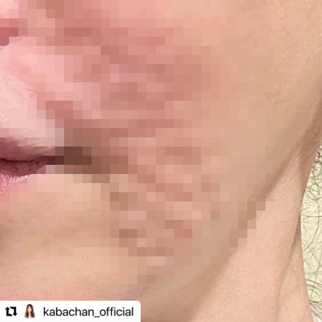 西川礼華さんのインスタグラム写真 - (西川礼華Instagram)「先日KABA.ちゃん（@kabachan_official）にご来院頂きました。いつもありがとうございます😊  #Repost @kabachan_official with @use.repost ・・・ お肌のメンテナンス〜♪『湘南美容クリニック新宿本院』にて✨✨  担当医は、絶対的な信頼を寄せる西川先生👏👏👏👏  前回の糸リフトの経過をみていただき、気になる箇所を伝え丁寧にカウンセリングしていただきます〜そして、先生にメニューを決めていただきます❣️  今回の施術メニューは、、、、　  ・ウルトラリフトプラスハイフ（顔・首）　 ・ベビースキン水玉リフティング(顔・首) ・ボトックス注射(眉間・目尻・アゴ) ・女優注射(法令線・口横)  ウルトラリフトプラスハイフで顔、首をキュっと引き締めてもらい、糸リフトの効果を持続〜😊  大好きなベビースキンでつやつやモチモチお肌に✨💕  ボトックスでは、年齢の敵であるシワちゃんをやっつけ、女優注射で更にやっつけていただきました😁👍  1枚目は、ボトックス注射ちぅ、2枚目は、女優注射後のお肌なんですけど、、、  。。。。。の集合体がちょっとアレなのでモザイク処理しちゃいました😅ごめんなさい🙇‍♀️  ダウンタイム中は、録画してた映画を見たり、本を読んだり、すすき🐈と遊んだり、、、お家から出ません🤣  るんるんタイムまで待てない〜ケド、待つの🤭宜しくどーぞ❣️  #湘南美容クリニック新宿本院  @sbc_shinjukuskin  #担当医は絶対的な信頼を寄せる西川先生　 @ayakanishikawa  #施術メニュー #ウルトラリフトプラスハイフ #ベビースキン水玉リフティング  #ボトックス注射 #女優注射 #ダウンタイム中は家から出ません #るんるんタイムまで待てないケド待つの #宜しくどーぞ #今回もありがとうございました  #pr」4月28日 10時22分 - ayakanishikawa