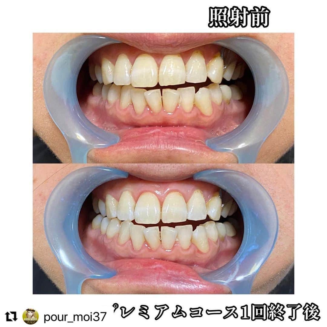 30DAYSホワイトニングキットのインスタグラム：「今回は三重県の 「店名プフモア（@pour_moi37）」さまをご紹介します❤️🌹💌  セルフホワイトニング以外にもよもぎ蒸しやヘッドマッサージなどの癒やされそうなメニューがあるお店なのでぜひ行ってみてくださいね🌱  🏠お店情報はこちら ⬇️⬇️   ・・・・・・・・・・・・・・・  #Repost @pour_moi37 with @use.repost ・・・ セルフホワイトニング🦷 オーラルケアの一つとして 定期的に取り入れてたいNo.１  歯を白くはもちろん✨ 口内環境のバランスを整え、 虫歯や口臭の予防✨  そして、 健康のために 口内フローラを整えていきましょう✨ 気になる方はお問い合わせください❤︎  #セルフホワイトニング #ホワイトニング @bihaku_official  #美歯口ホワイトニング  #オーラルケア #口内フローラ #歯のホワイトニング」