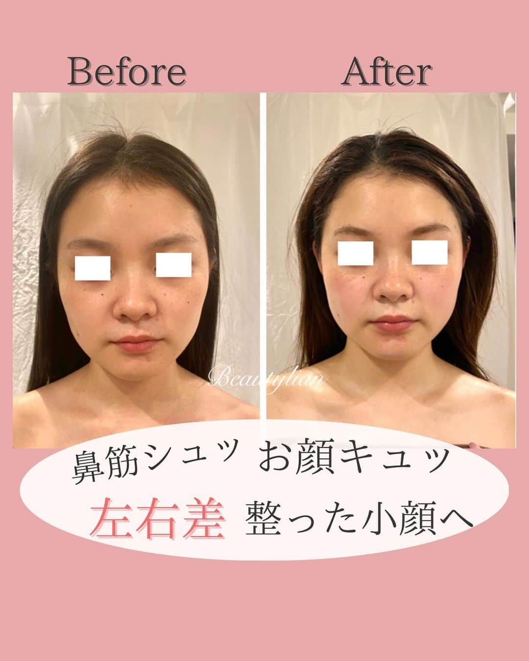 Eternal Total Beauty Salonのインスタグラム：「【小さいお顔がもっと小顔に♪】 ⁡ ⁡ お顔の位置が本来の正しい位置に戻ったのがとても分かりやすい変化かなと思います。 ⁡ ⁡ ⁡ こちらのお客様、元々お顔の骨格はとても小さいです😌ビフォーと比べると目の距離や位置、 首周りが特に変わられましたね ⁡ ⁡ ⁡ 本来あるべき位置に戻り、お客様の意識も変わるとお顔の印象やオーラまでもが変わります💛 ⁡ ⁡ ⁡ 日頃の姿勢はお顔にも影響するのでとても大事で、良くやってしまいがちな3枚目、4枚目の体制には気を付けましょうね！ ⁡ ⁡ ⁡ ⁡ 人間の【脳🧠】が覚えて習慣化するまでには約3週間はかかります。 なので最初のうちは意識していないと直ぐにいつもの【癖】が発動します ⁡ ⁡ ⁡ こちらは初回から3回目までは間隔を空けずにお越し頂いている理由と少し似ていますね🤭 ⁡ ⁡ ⁡ 正しい姿勢や体勢に慣れてくると 良くない姿勢や癖が発動している時に今度はそこに気付ける様になりますよ✨ ⁡ ⁡ ⁡ ⁡ ⁡ ⁡ ⁡ ⁡ 【小顔効果倍増なペース】 ＊初回から含めて3回目までは週1から空けても2週に1回のペースを推奨しております。 最初に土台を作り戻りにくく定着させる為です。 ⁡ ご新規様は3回分のご予約をオススメ致します。トップページのLINEから承っております🙇‍♀️ ⁡ ⁡ ⁡ ⁡ ⁡ ⁡ 🌹オールハンド60分(ヘッド、小顔矯正、オイル)初回¥15000 ⁡ 🌹インディバ付き90分(ヘッド、小顔矯正、インディバ、オイル) 初回¥20000 ⁡ ⁡ ⁡ ⁡ ⁡ ＊＊＊＊＊＊＊＊＊＊＊＊＊＊＊＊＊＊＊＊ ⁡ ⁡ 小顔矯正/インディバエステ ⁡⁡営業時間　11:00〜20:00(18:30最終受付) ⁡ 定休日　不定休 ⁡ ⁡ ご予約はDMもしくはLINEから🙇‍♀️✨ 【@beautylian_kogao】 ⁡ ＊＊＊＊＊＊＊＊＊＊＊＊＊＊＊＊＊＊＊＊ ⁡ #顔の歪み改善 #小顔矯正東京 #巻き肩解消 #エラ張り解消 #むくみ解消 #リフトアップ #かおやせ #花嫁美容 #たるみ解消 #目黒小顔#肩凝り改善 #二重あご解消  #ほうれい線改善#小顔サロン東京 ⁡ ⁡ ⁡」