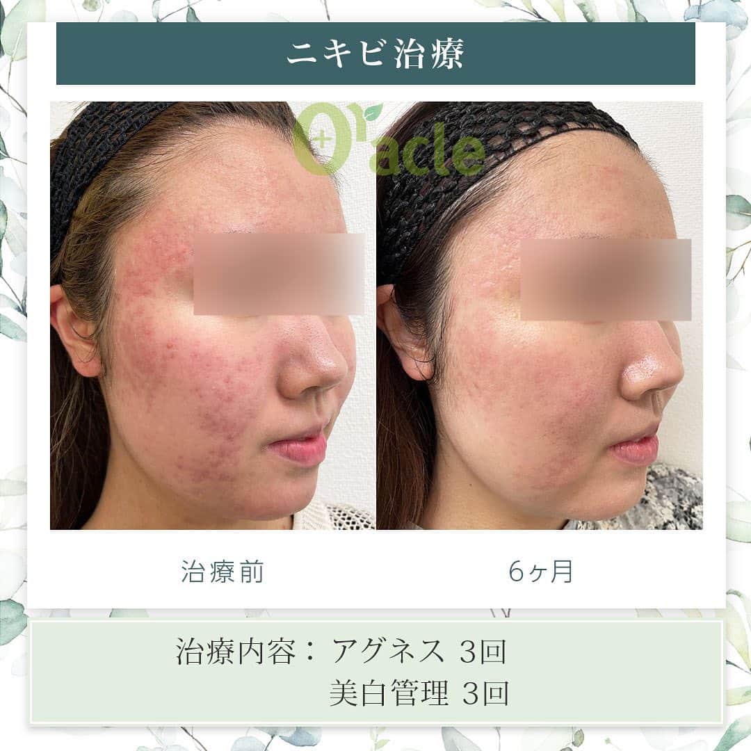 オラクル美容皮膚科東京新宿院さんのインスタグラム写真 - (オラクル美容皮膚科東京新宿院Instagram)「|◤ニキビ治療◢| ☞アグネス3回経過  《治療内容》 アグネス全顔3回 美白管理3回  炎症ニキビが減り赤みもかなり軽減されています。 維持とさらに赤みの治療には10PLがおすすめです。  ☑️アグネス ニキビの原因となる皮脂腺を直接破壊し、破壊した毛穴からの再発を半永久的に防ぐニキビの根本治療です。 ビリビリしたお痛みがあるので、麻酔をして痛みを軽減させます。 ⁡ 【ダウンタイム】 赤み：2~3日 腫れ：数日～2週間ほど出る方もいる 内出血：1~2週間 洗顔、メイクは翌日以降◎ ⁡ 【料金】 ☞初回部分　19,800円 ☞部分通常　22,000円 ①こめかみ片側 ②鼻（眉間〜鼻） ③顎 ①②③のいづれか1箇所  ☞⁡半顔　44,000円 ①額全体 ②頬片側 ③顎下～首 ①②③のいづれか1箇所  ☞全顔　66,000円  ※別途、麻酔代2,200円  ※渋谷院ではアグネスモニター募集中 ⁡ ☑️美白管理 ニキビのお肌は乾燥している方が多く、その乾燥がニキビの原因になっているいることも… 美白管理では、お肌の状態に合わせてビタミンＣ、もしくはトラネキサム酸をお肌に導入していきます。 ⁡ 【料金】 1回　11,000円(税込)  ※薬剤込▶︎トラネキサム酸orビタミンC ☞肌状態でお選びいたします。 ⁡ #アグネス #ニキビ治療 #ニキビ肌 #ニキビ跡 #ニキビケア #ニキビ肌 #ニキビ肌改善 #美肌　#ニキビの治し方 #肌ケア #肌質改善」5月2日 12時42分 - oraclejp